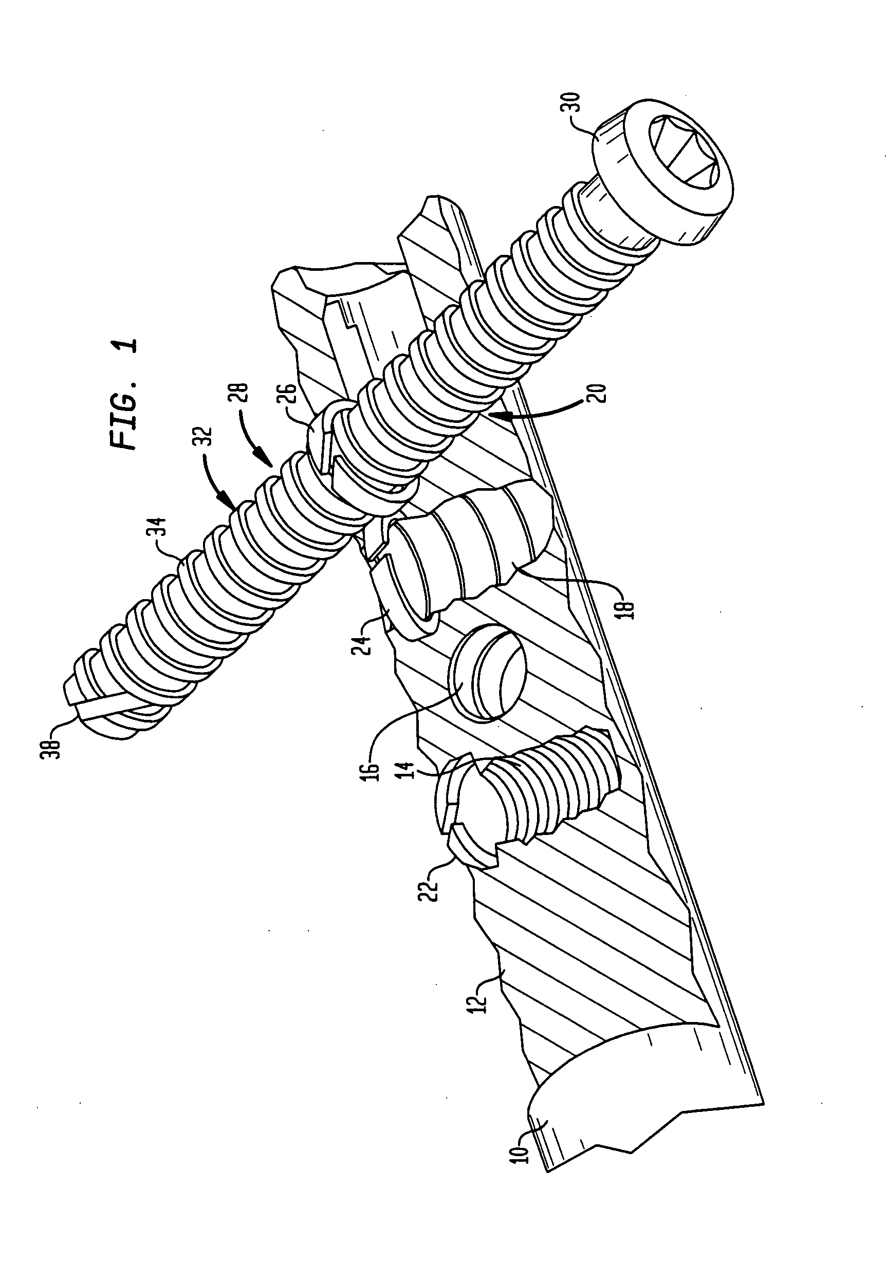 Implant for osteosynthesis