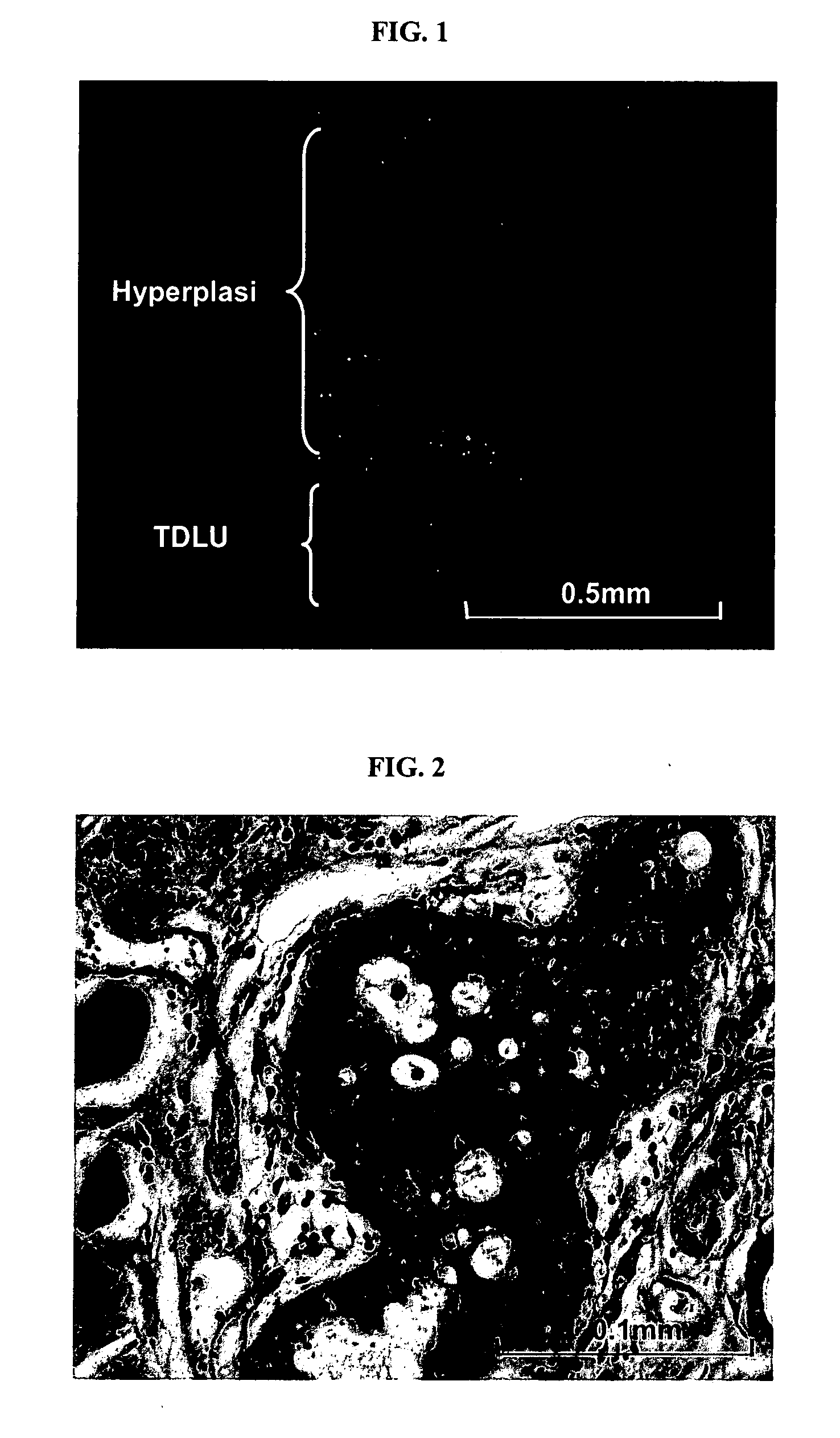 Reconstituted human breast tumor model