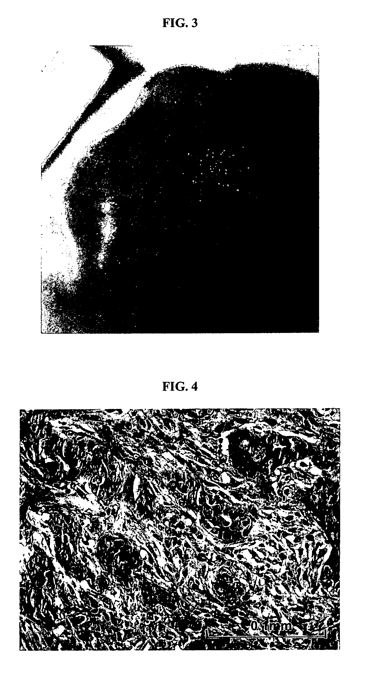 Reconstituted human breast tumor model