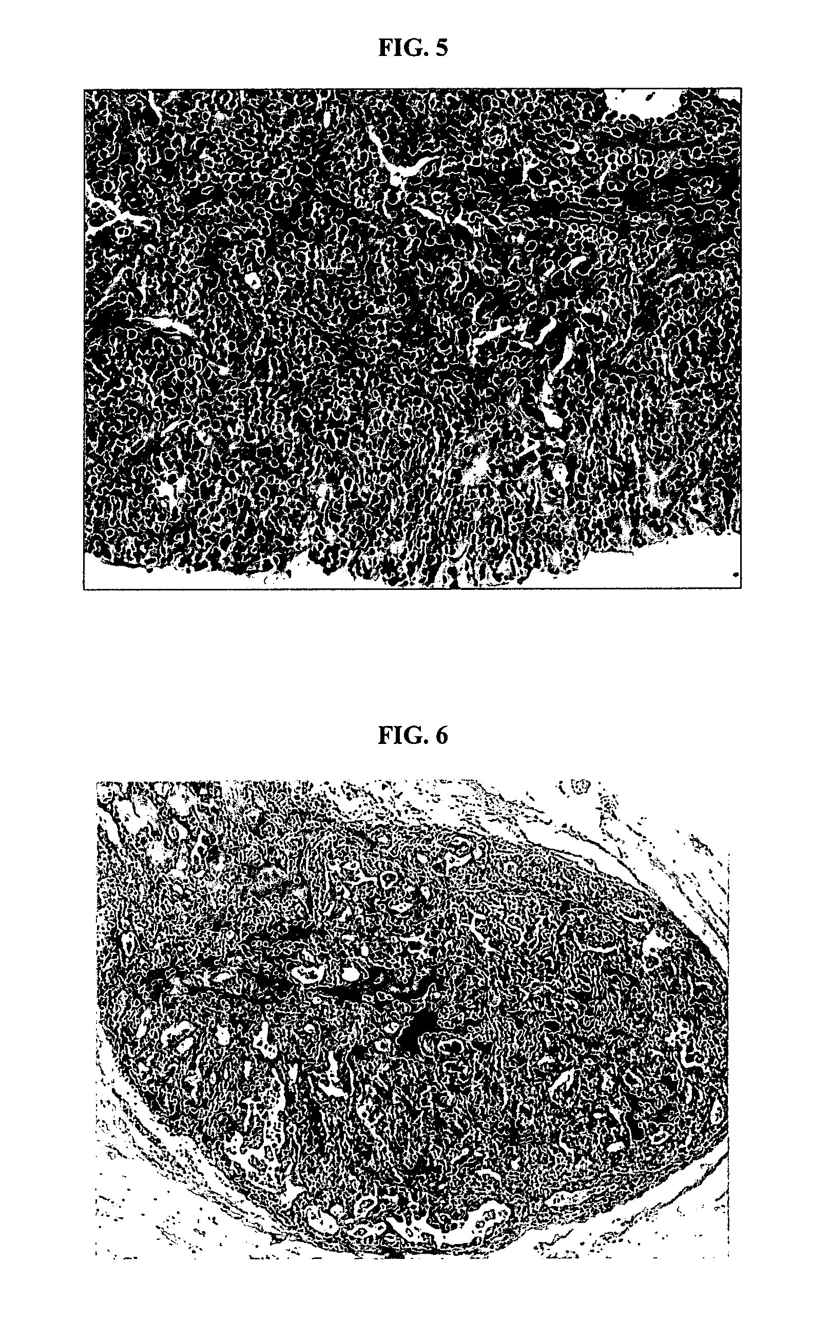 Reconstituted human breast tumor model