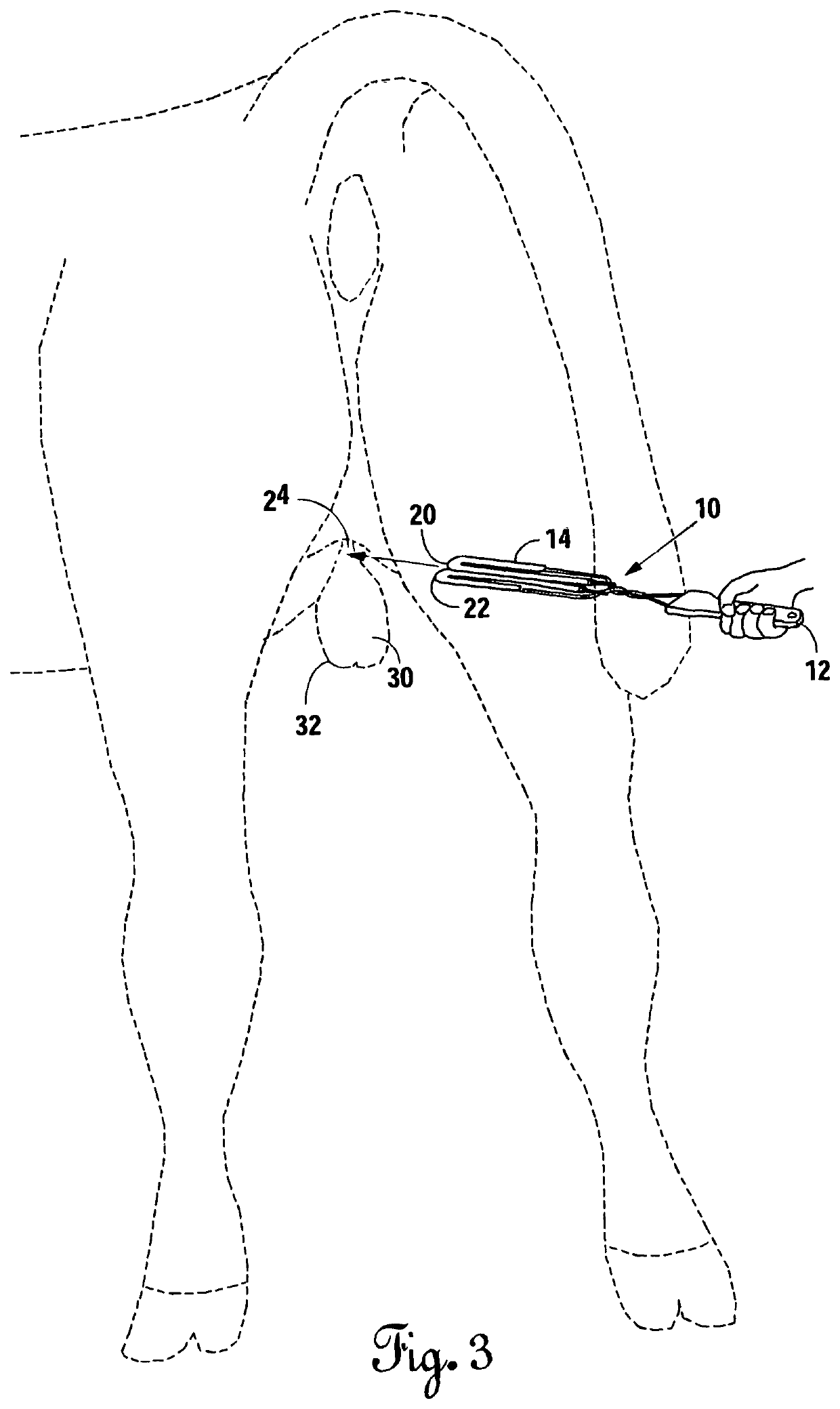 Device and method for mitigating the ascension of testicles during castration of livestock