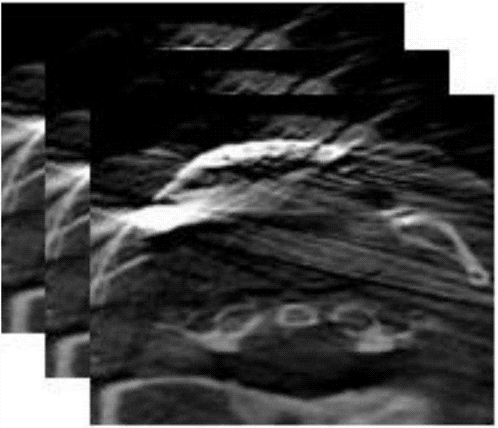 Data fusion method for oral CBCT image and laser scanning tooth grids