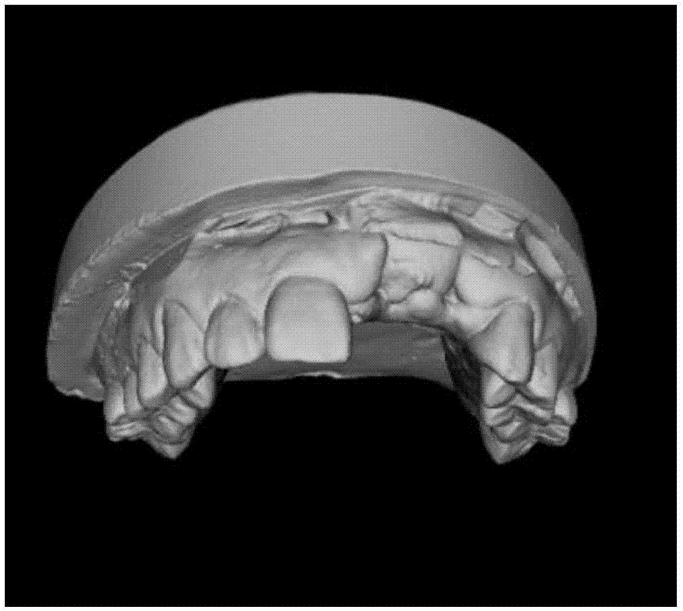 Data fusion method for oral CBCT image and laser scanning tooth grids