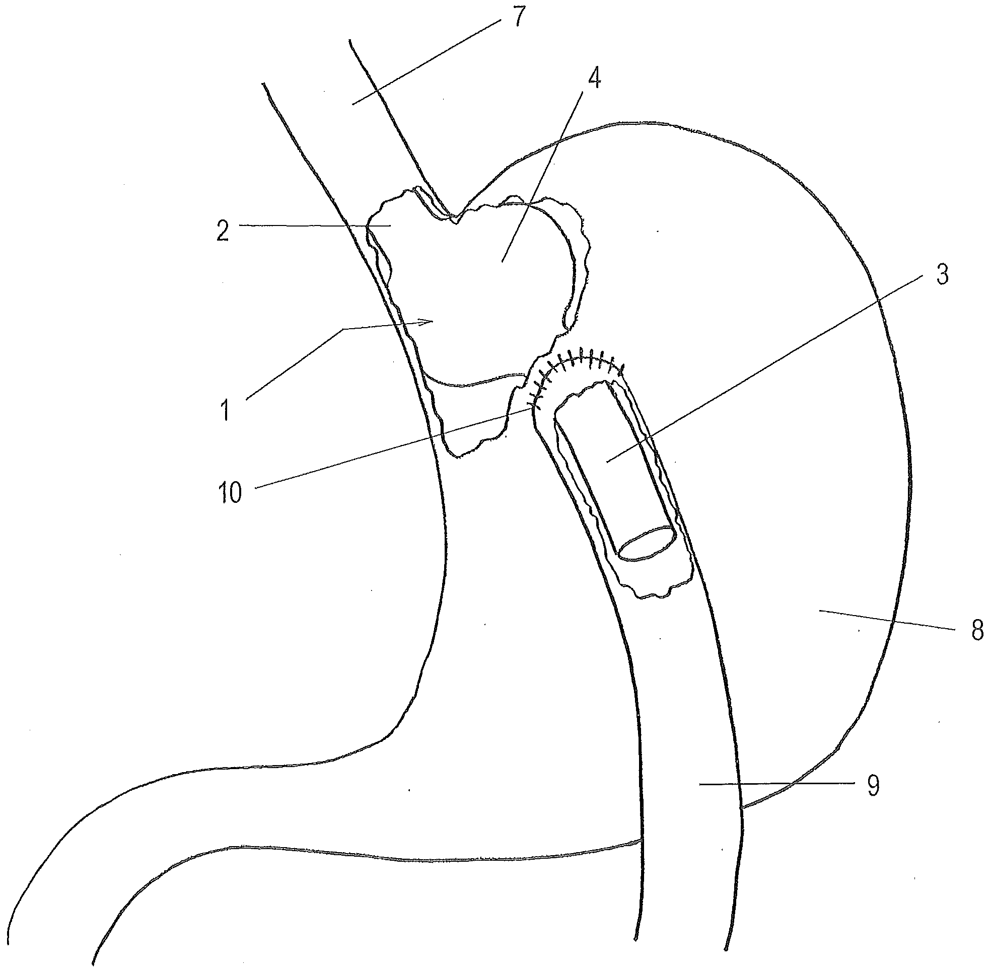 Medical Implant