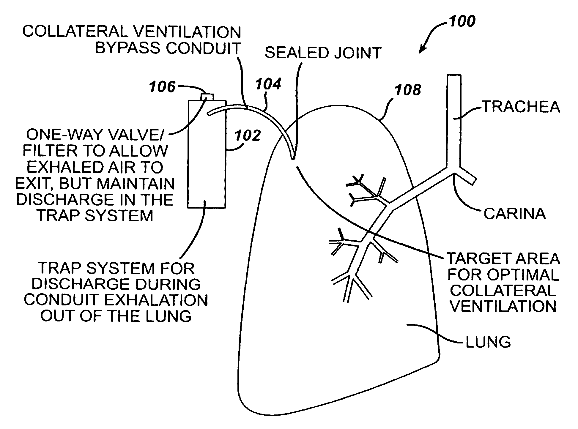 Variable resistance pulmonary ventilation bypass valve