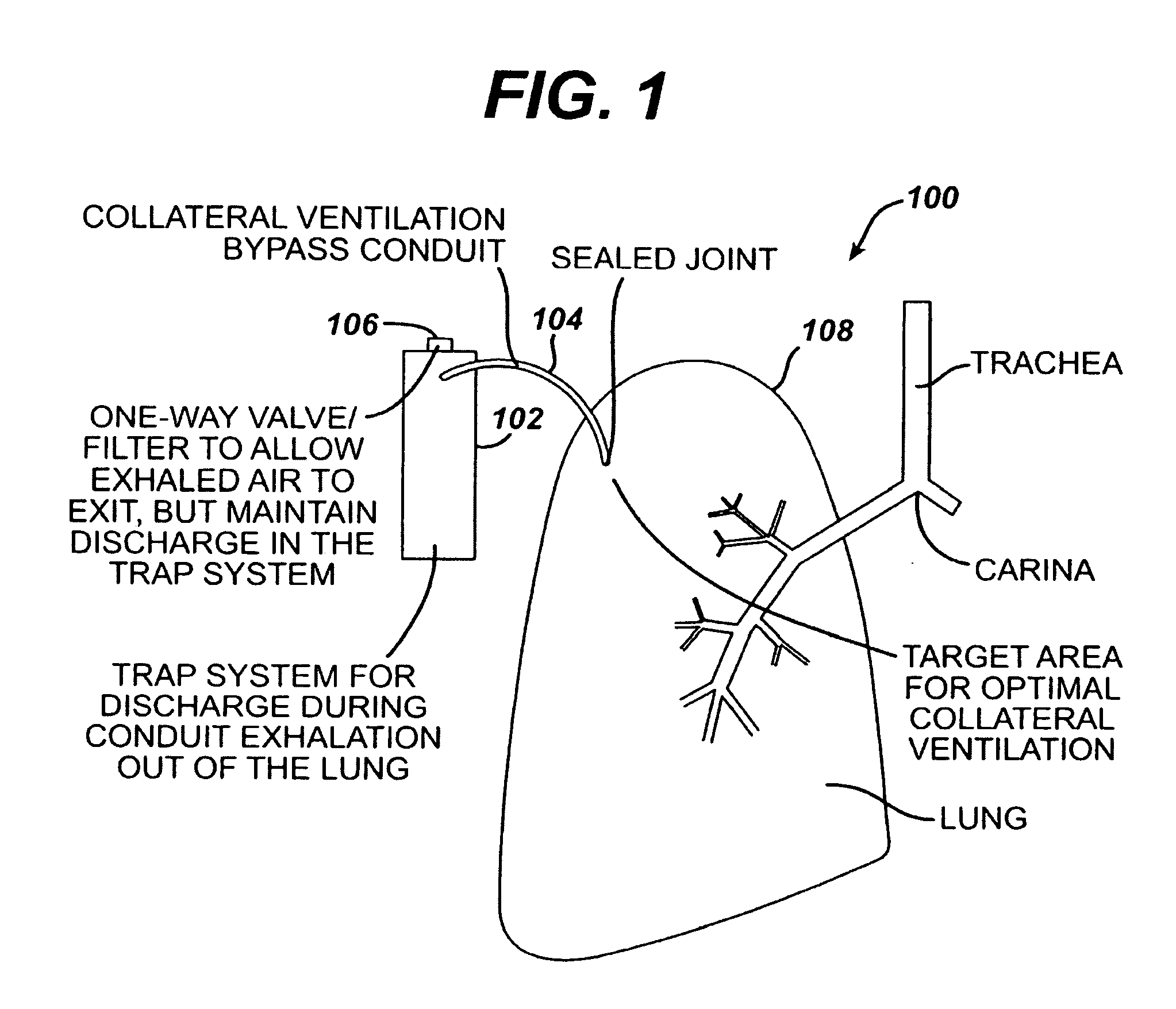 Variable resistance pulmonary ventilation bypass valve