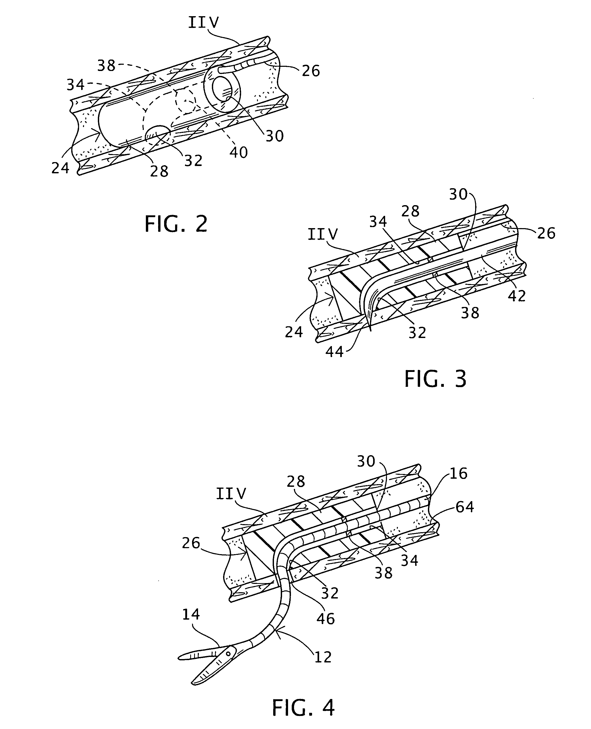 Trans-vascular surgical method and associated device