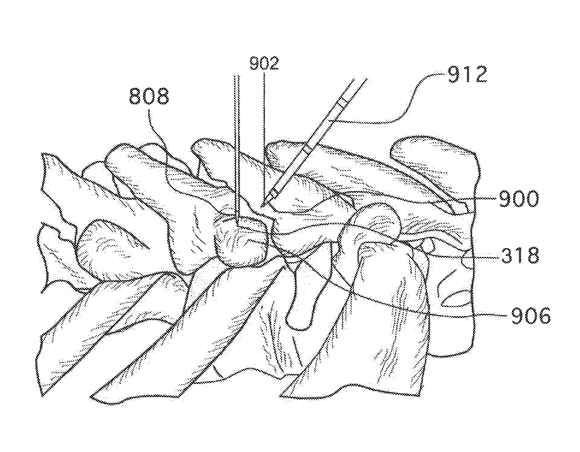 Method for Treating the Thoracic Region of a Patient's Body