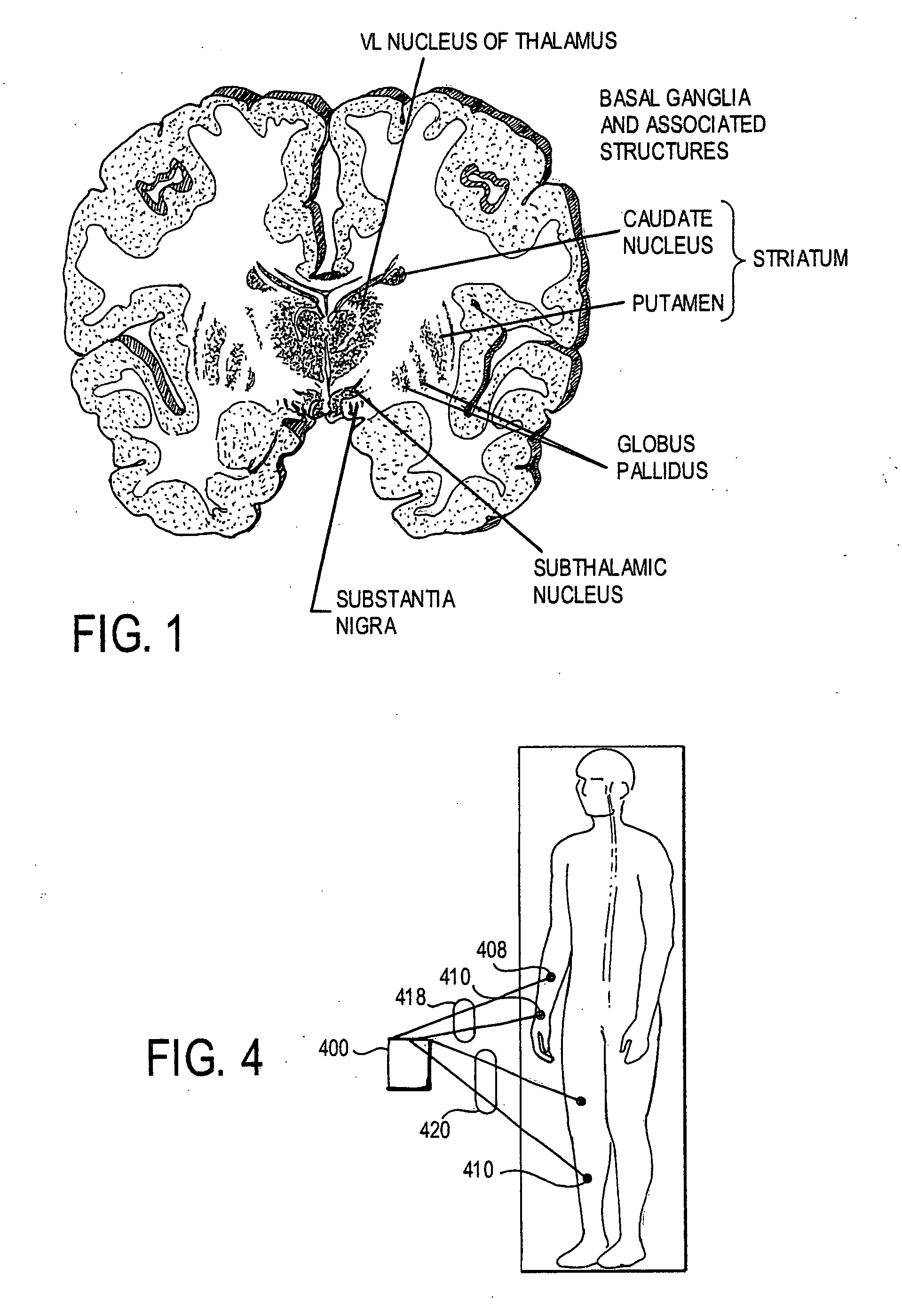 Surface stimulation for tremor control