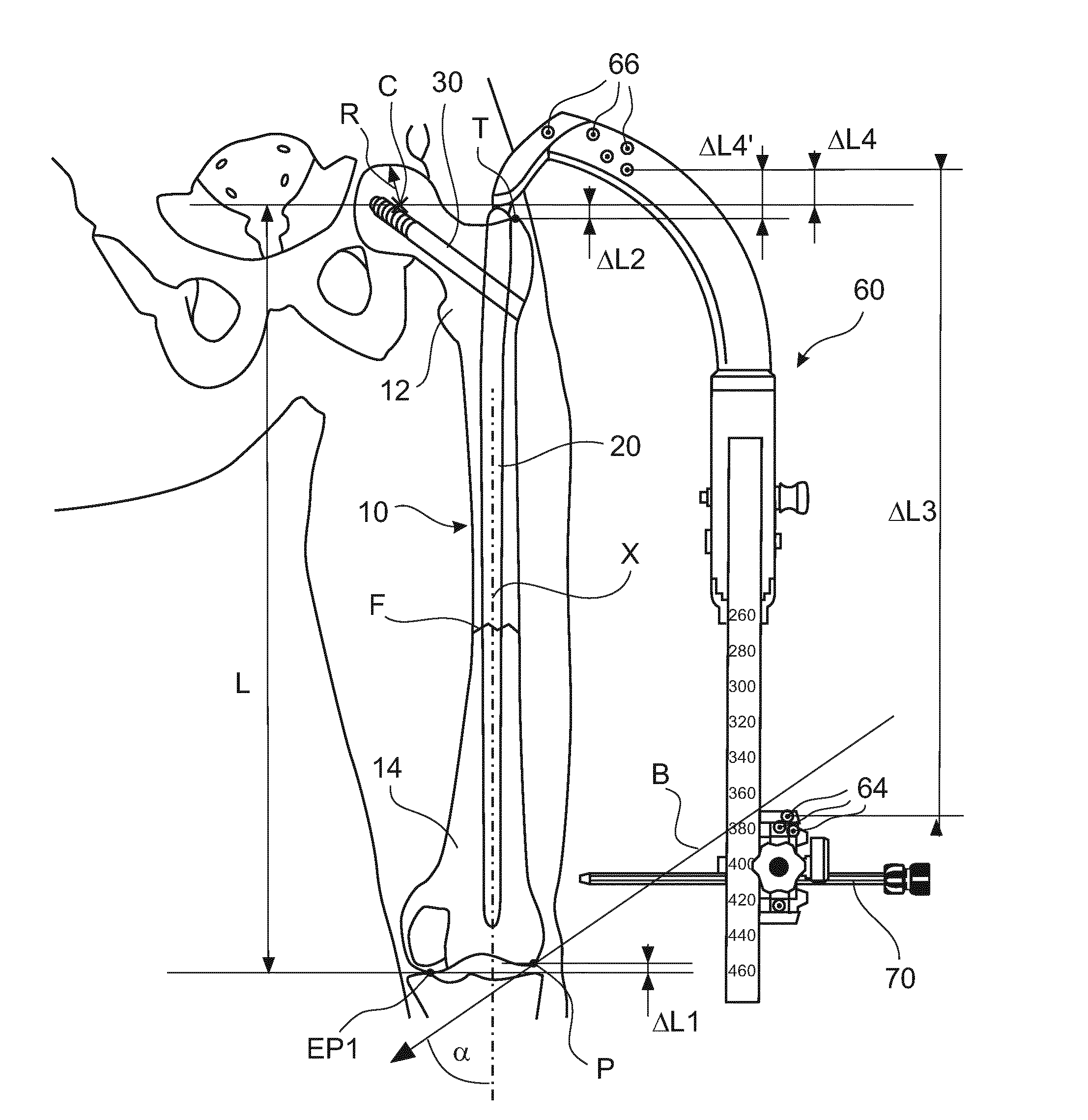 Bone length determination