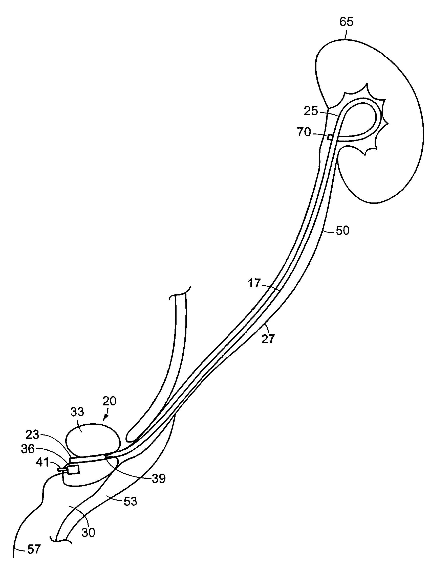 Ureteral stent with end-effector and related methods