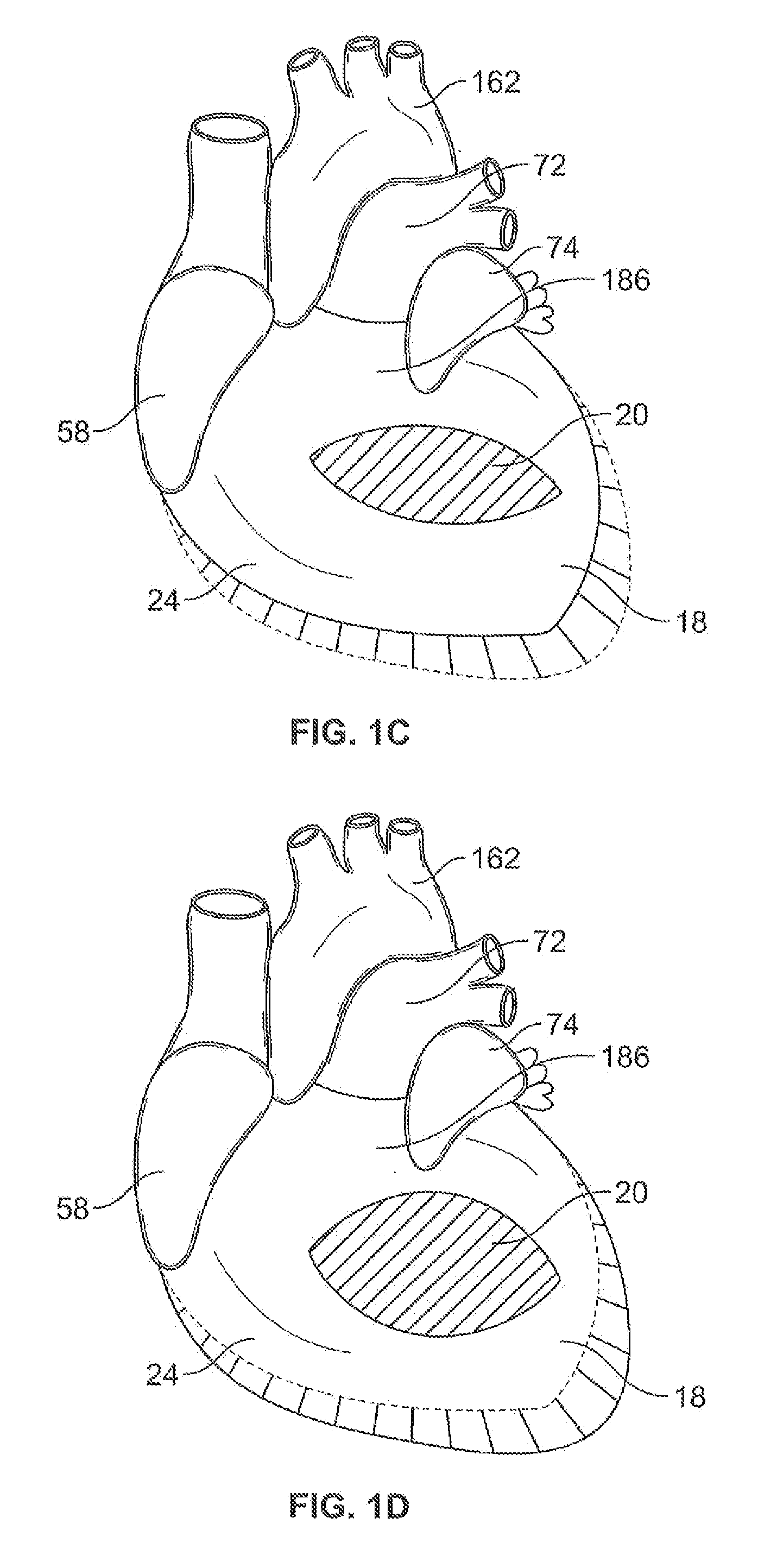 Systems for heart treatment