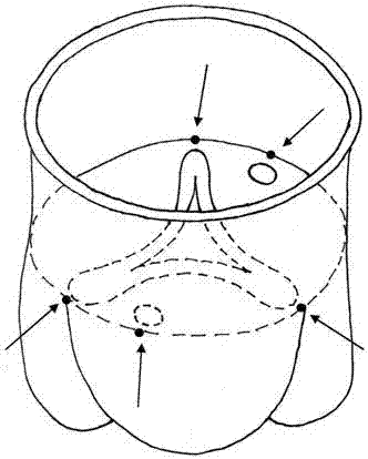 Application of aortic root forming process to Stanford A-type aortic dissection clinic surgical method