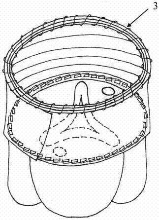 Application of aortic root forming process to Stanford A-type aortic dissection clinic surgical method