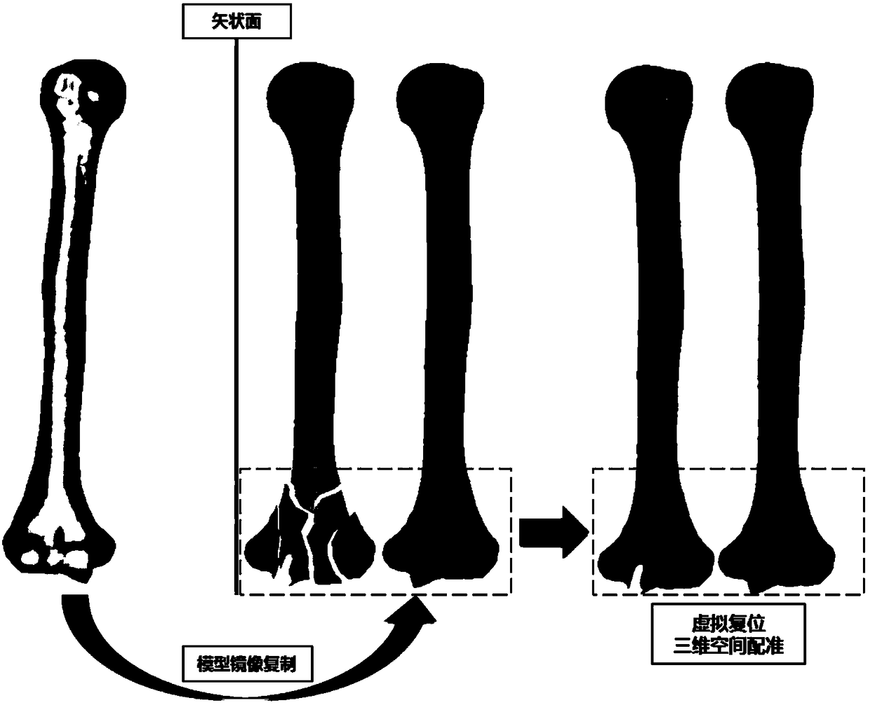 A method of 3D printing and repairing implants for bone articular surface reconstruction