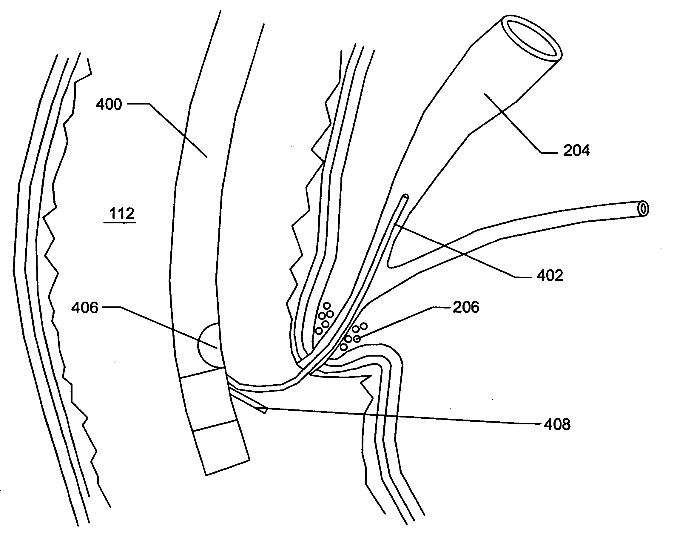 Expandable gastrointestinal sheath