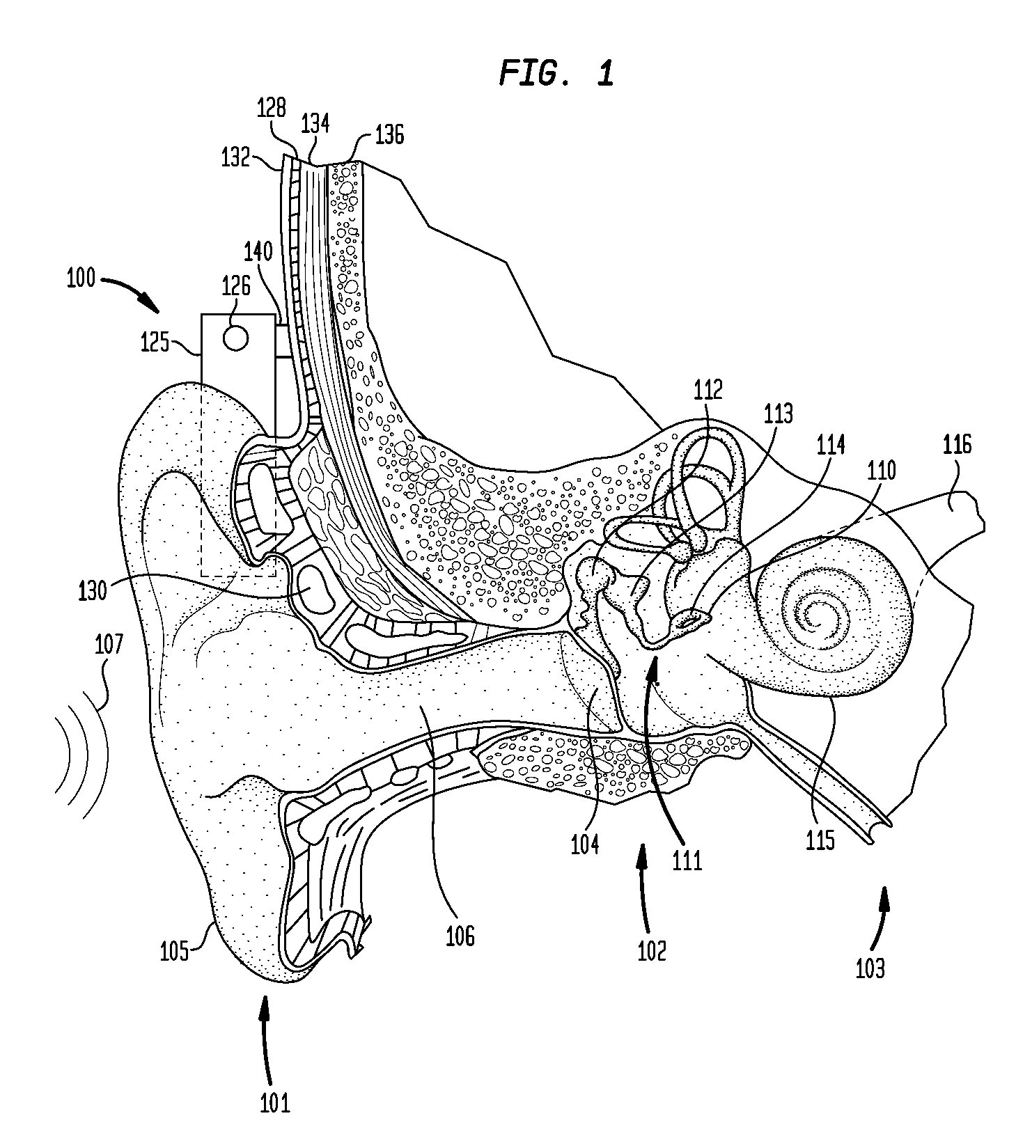 Bone conduction hearing device having acoustic feedback reduction system