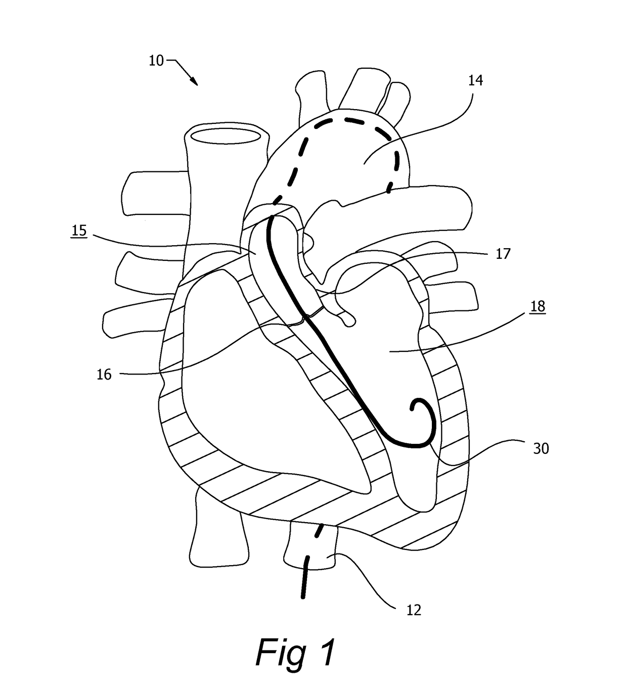 Catheter guide wire control device