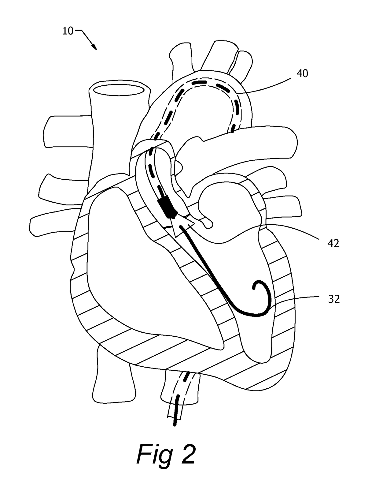 Catheter guide wire control device