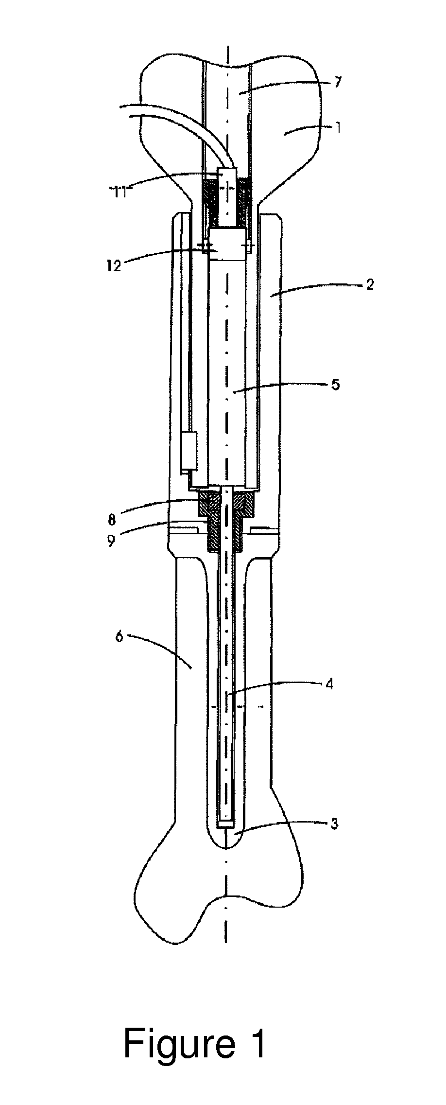 Growing prosthesis