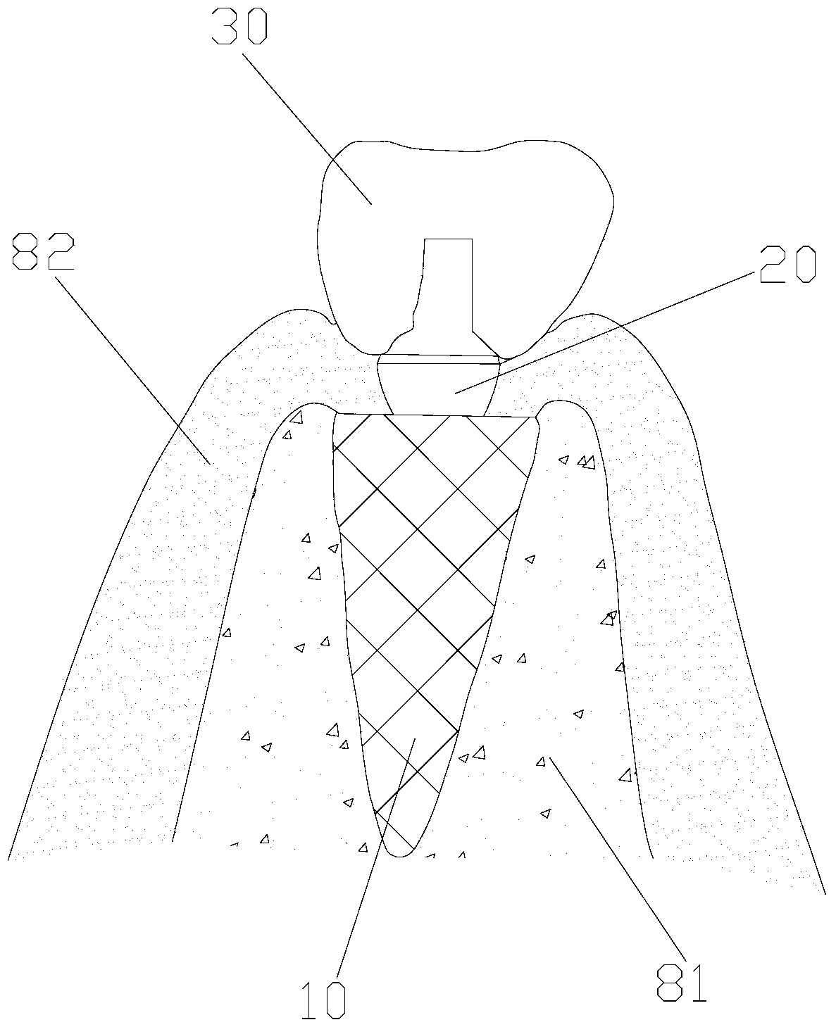 Anatomical root implant, dental restoration having the same, and manufacturing method of dental restoration