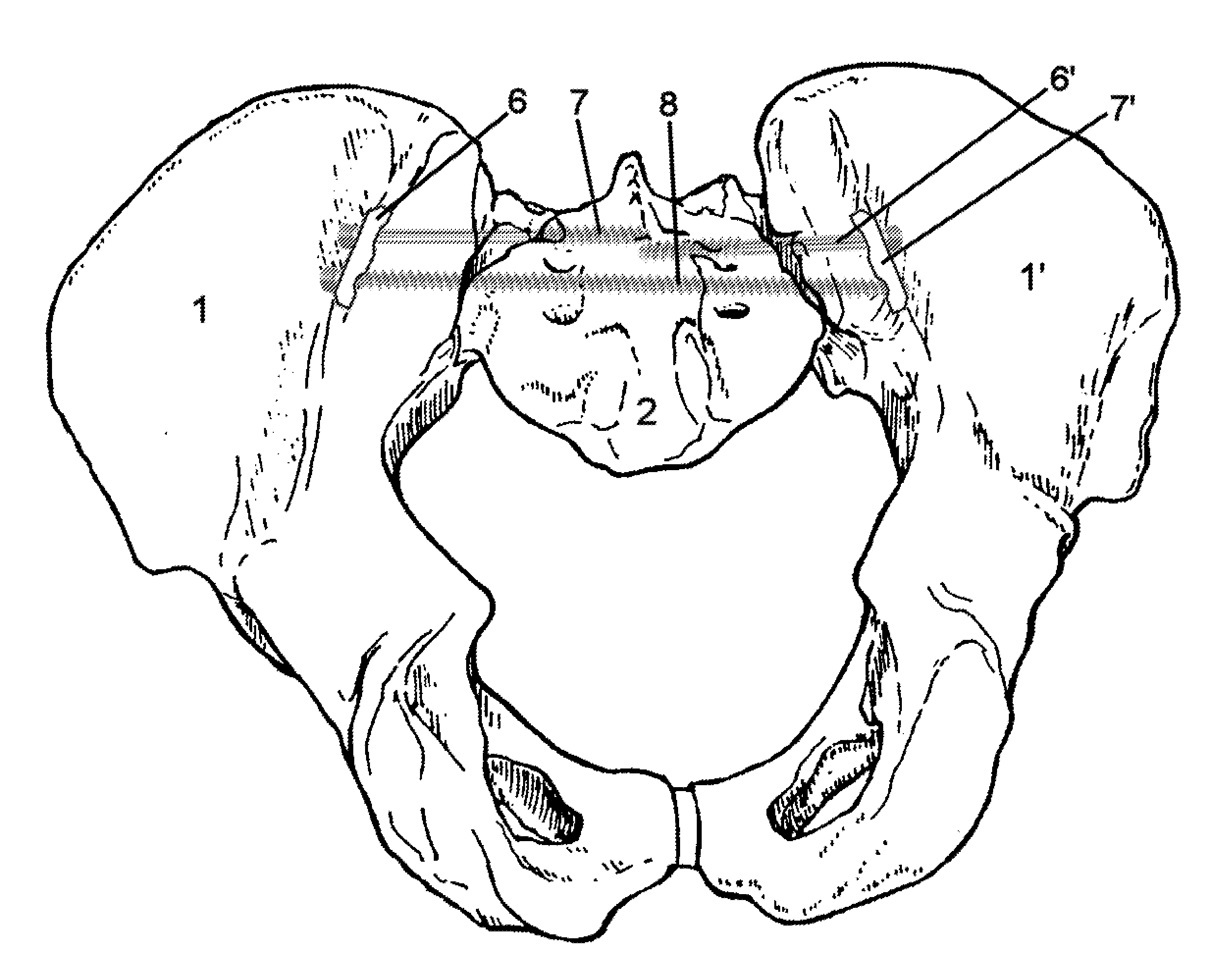 Method for Minimally Invasive Treatment of Unstable Pelvic Ring Injuries with an Internal Posterior Iliosacral Screw and Bone Plate