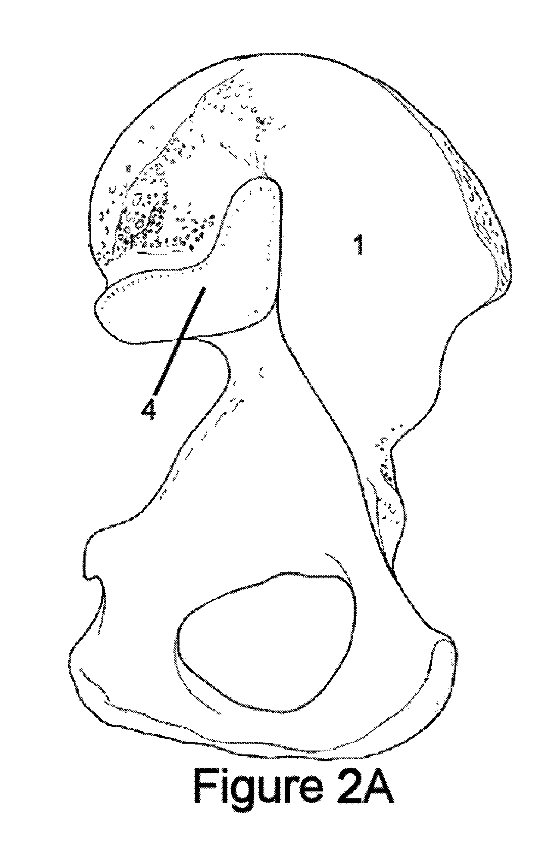 Method for Minimally Invasive Treatment of Unstable Pelvic Ring Injuries with an Internal Posterior Iliosacral Screw and Bone Plate