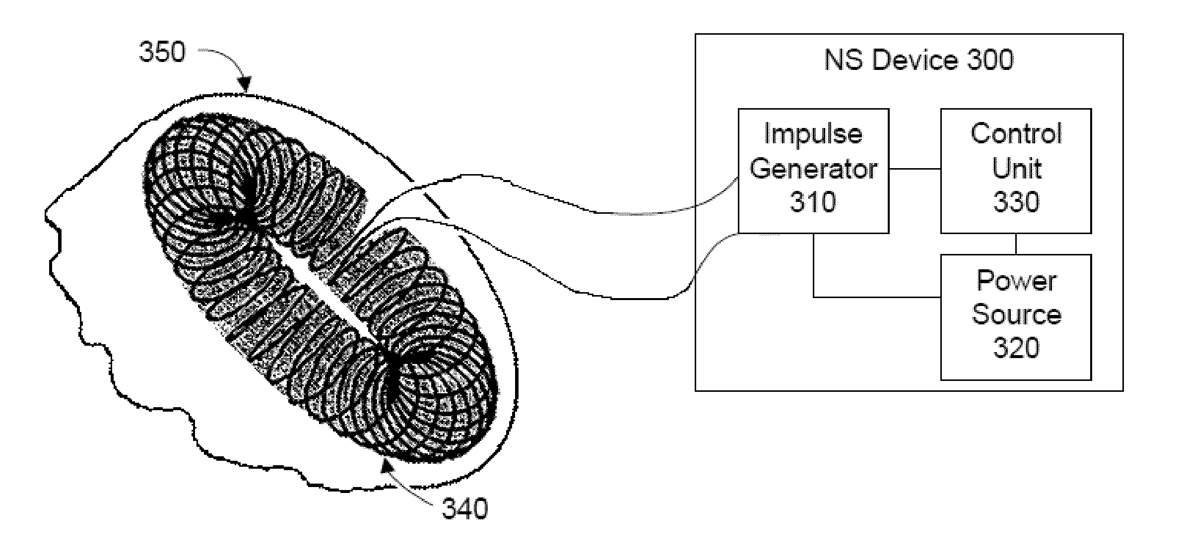 Non-invasive treatment of a medical condition by vagus nerve stimulation