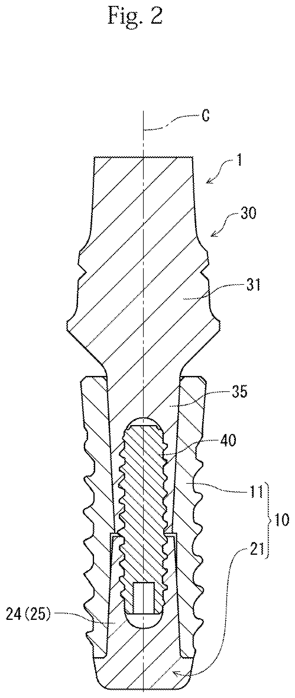 Fixture and implant