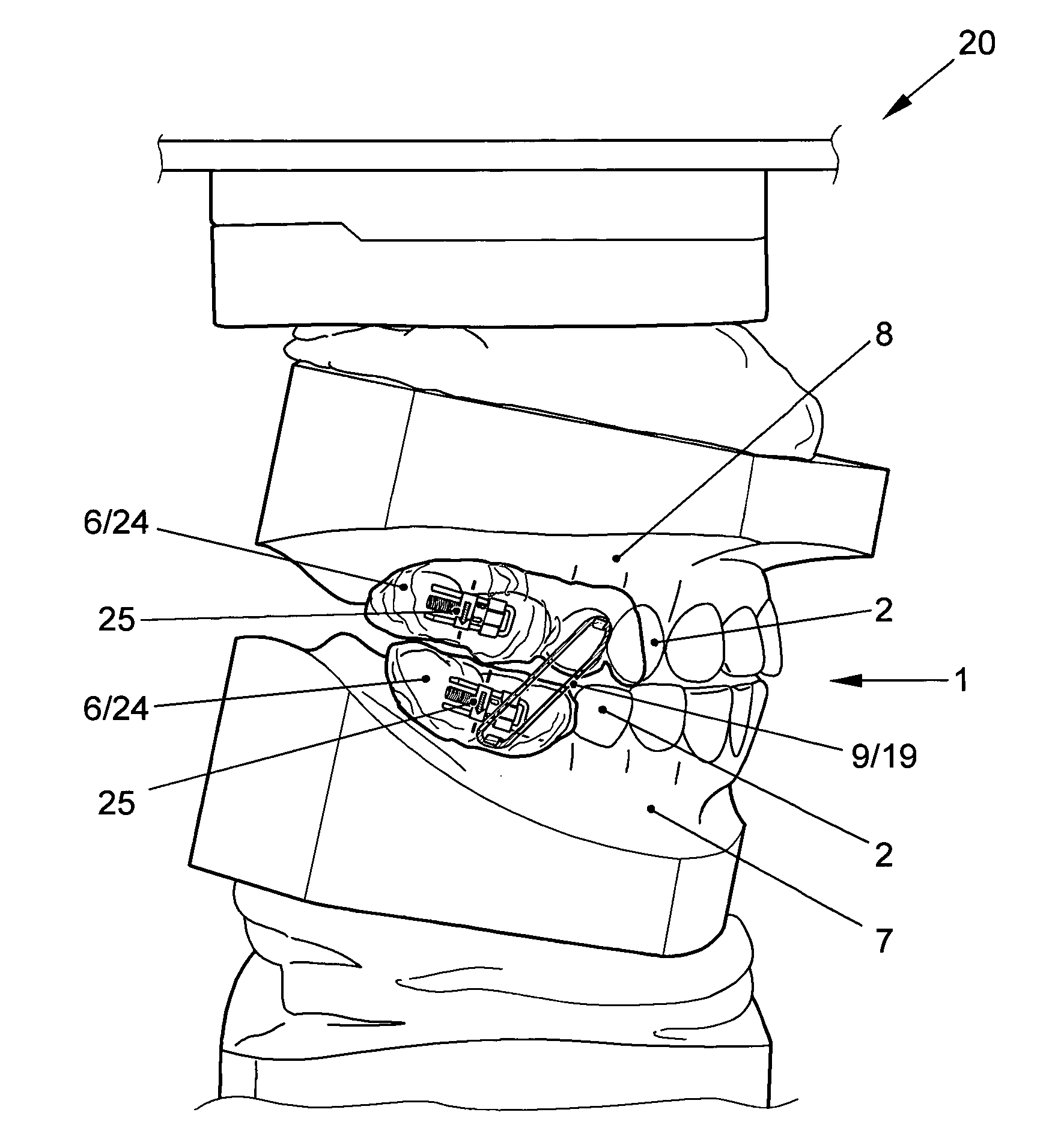 Apparatus for temporomandibular joint-related corrections of tooth position