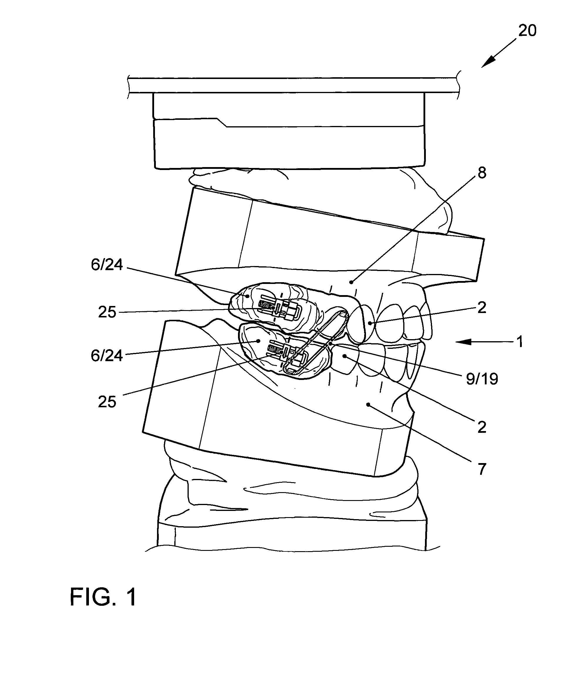 Apparatus for temporomandibular joint-related corrections of tooth position