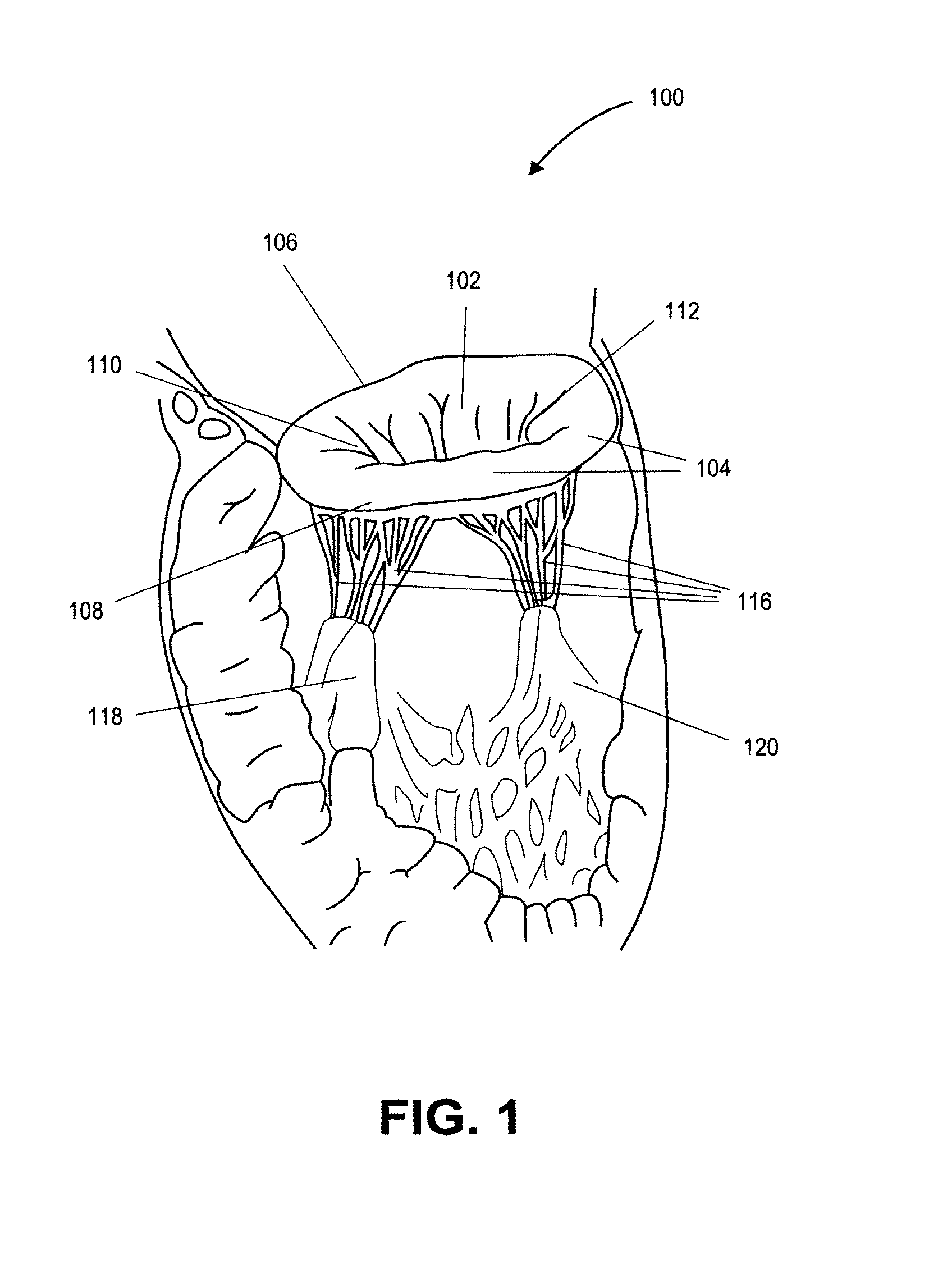 Heart valve prosthesis with collapsible valve and method of delivery thereof