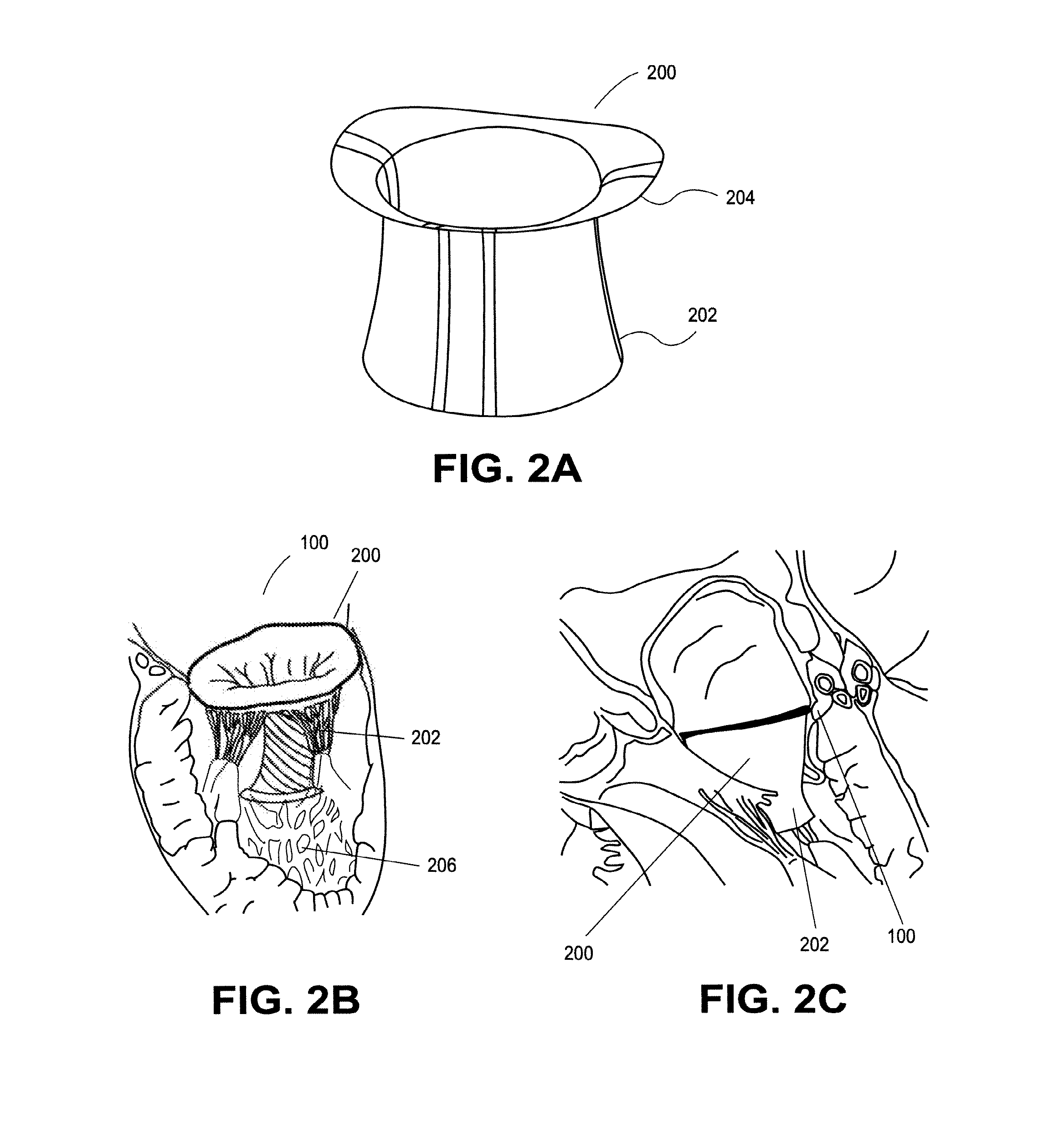 Heart valve prosthesis with collapsible valve and method of delivery thereof