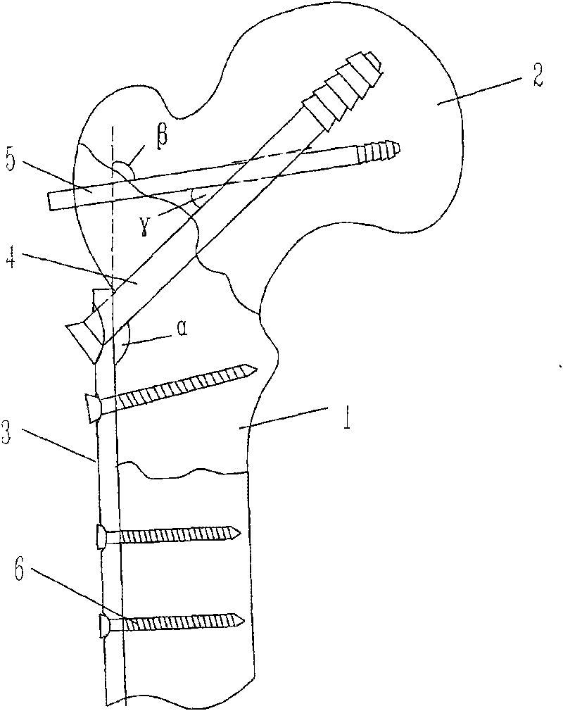 Triangle support bone fracture plate for treating fracture between femoral neck and tuberosity