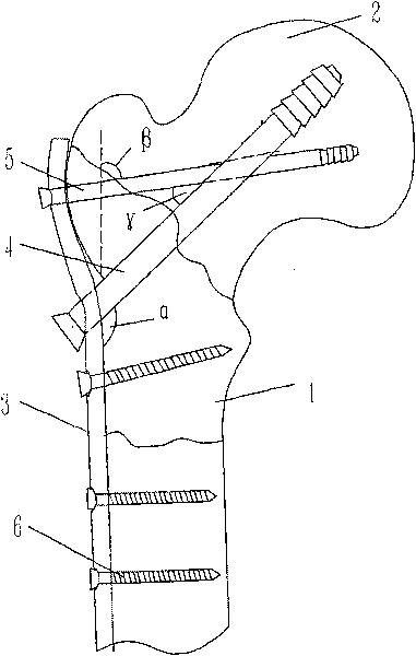 Triangle support bone fracture plate for treating fracture between femoral neck and tuberosity