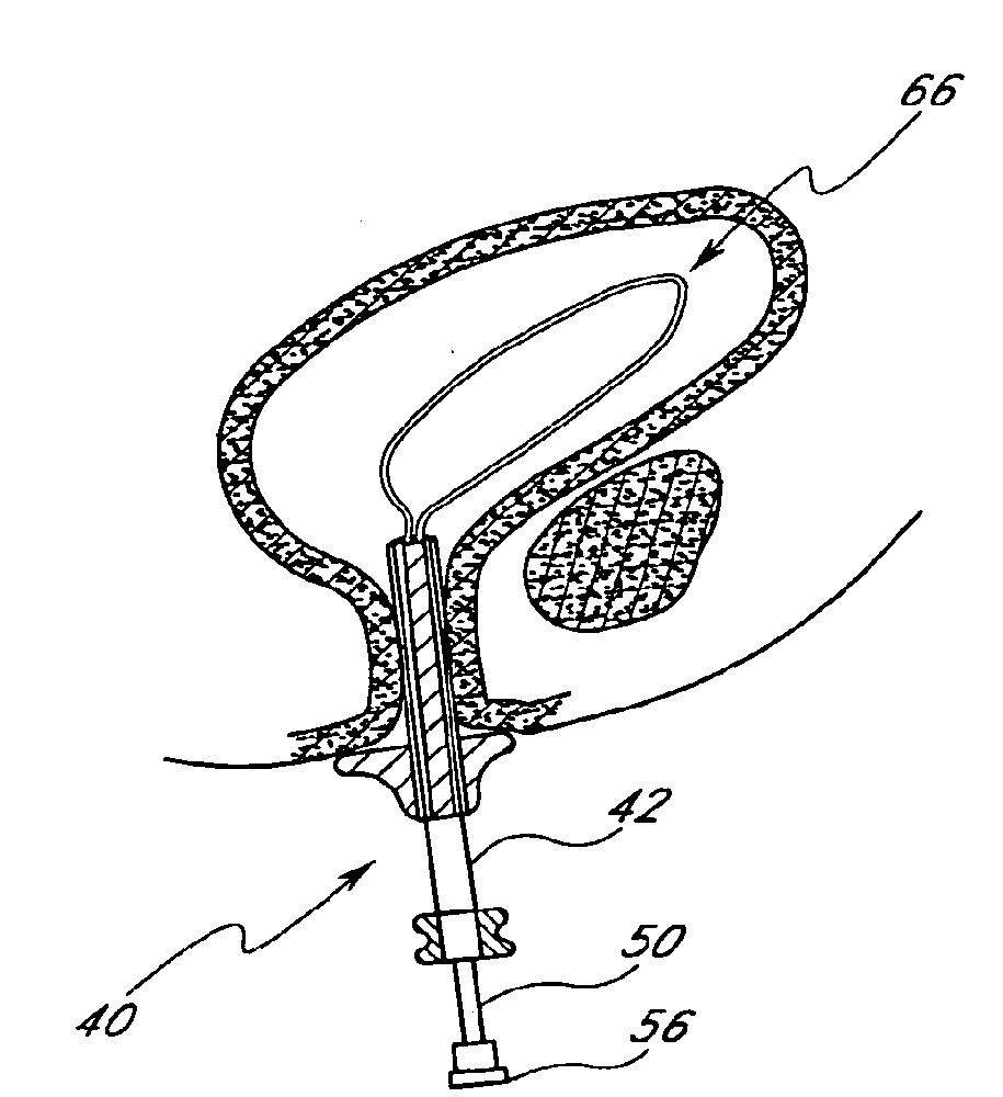 Method of treating benign hypertrophy of the prostate