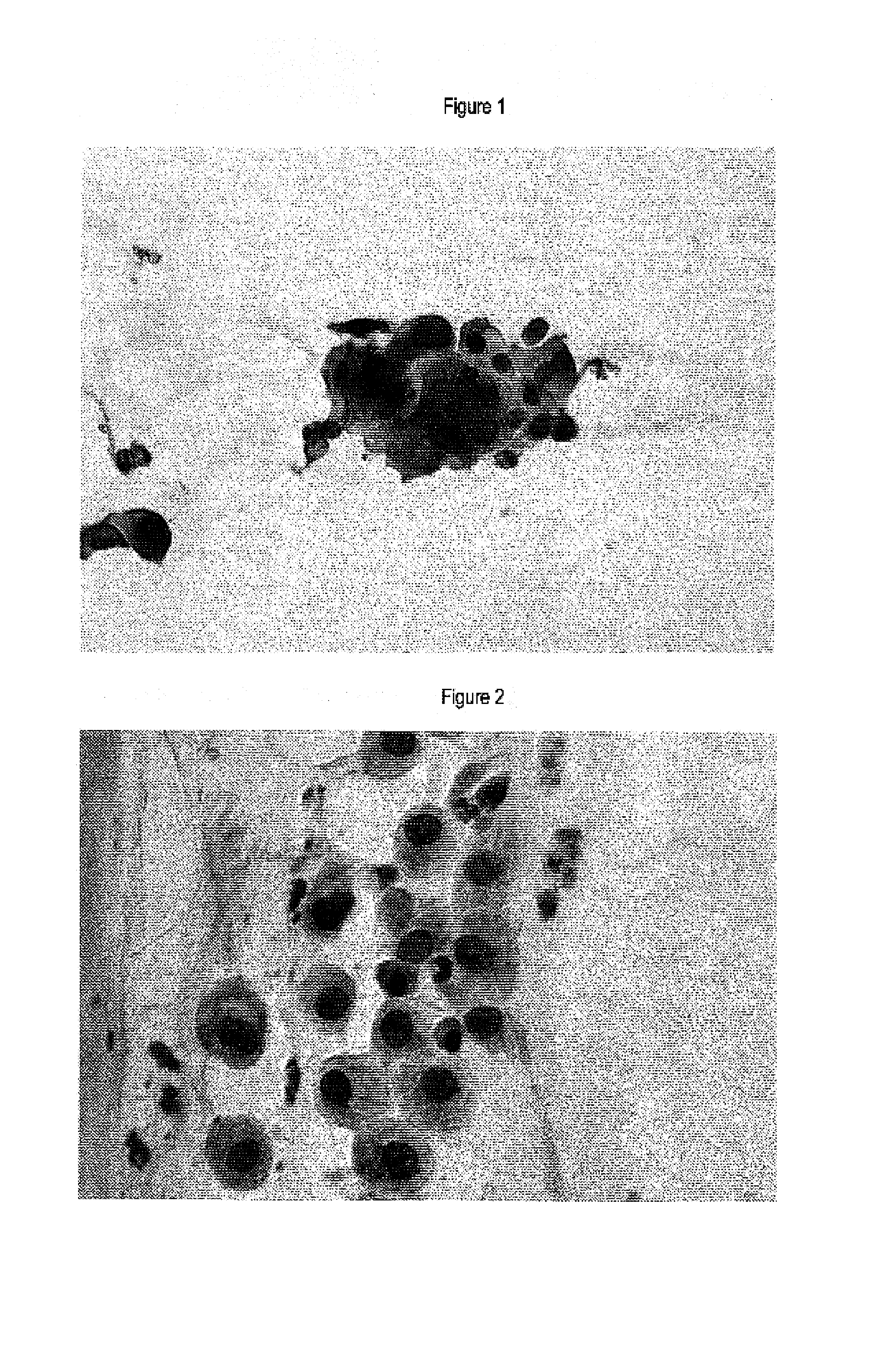 Method for discrimination of metaplasias from neoplastic or preneoplastic lesions