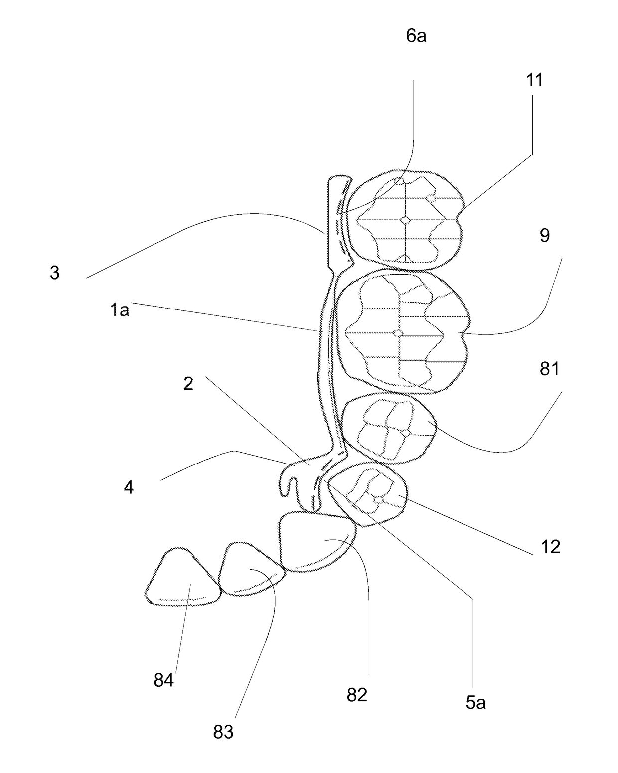 Orthodontic lingual device