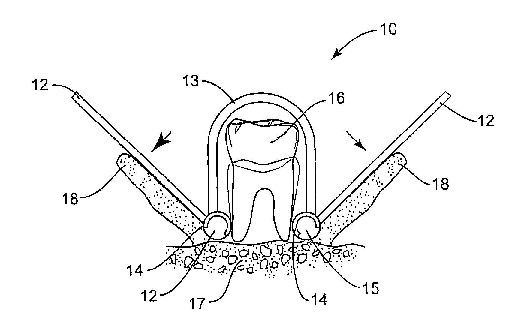 Reflected gingival tissue retractor device for surgical dental procedures, kit and method for use thereof