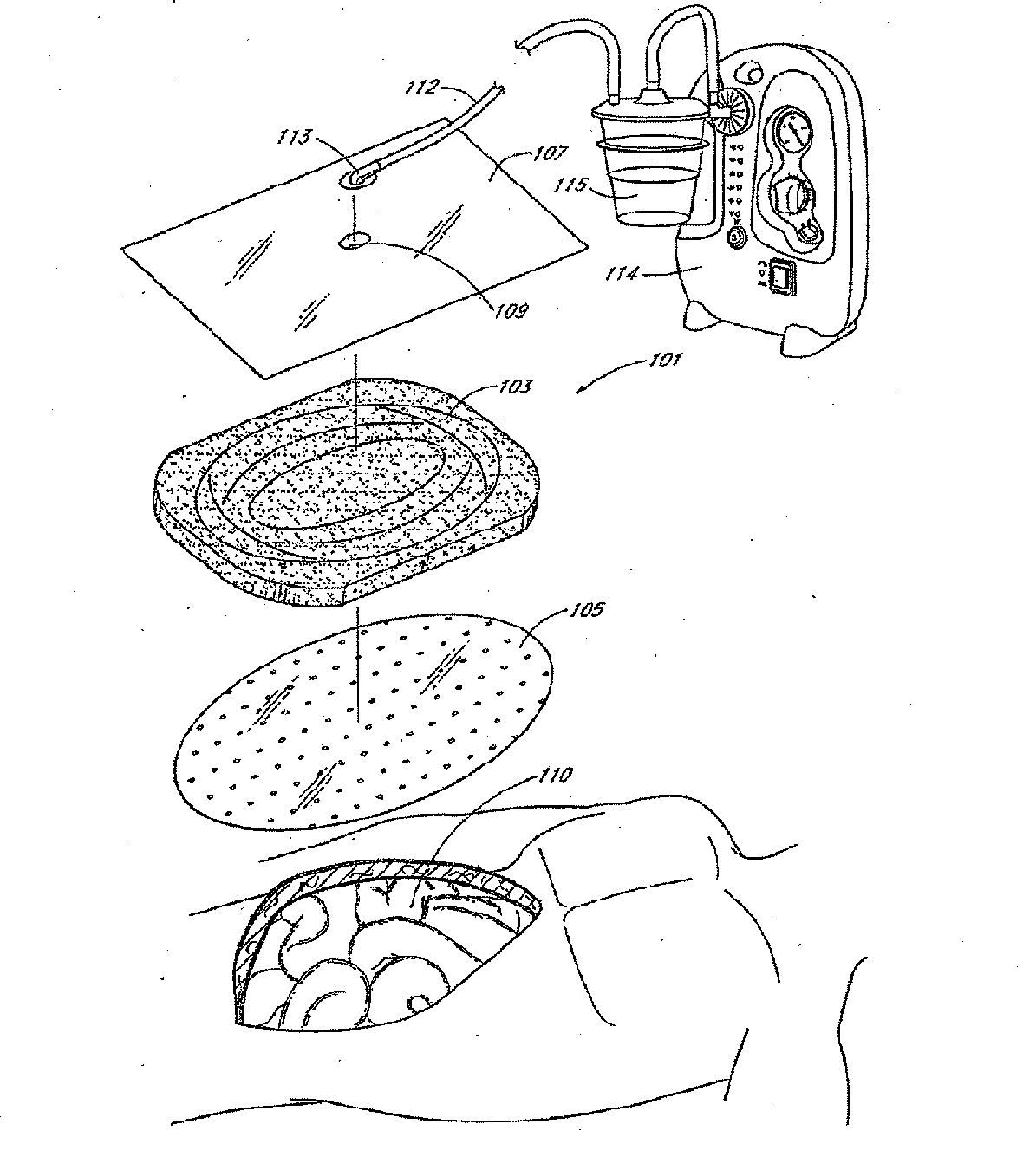 Devices and methods for treating and closing wounds with negative pressure