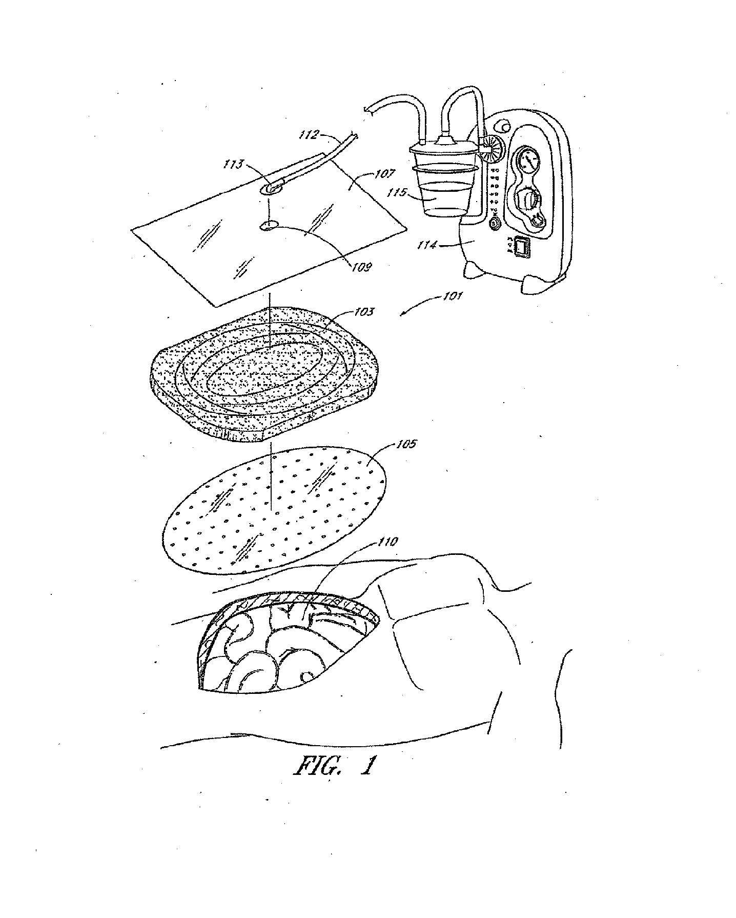 Devices and methods for treating and closing wounds with negative pressure