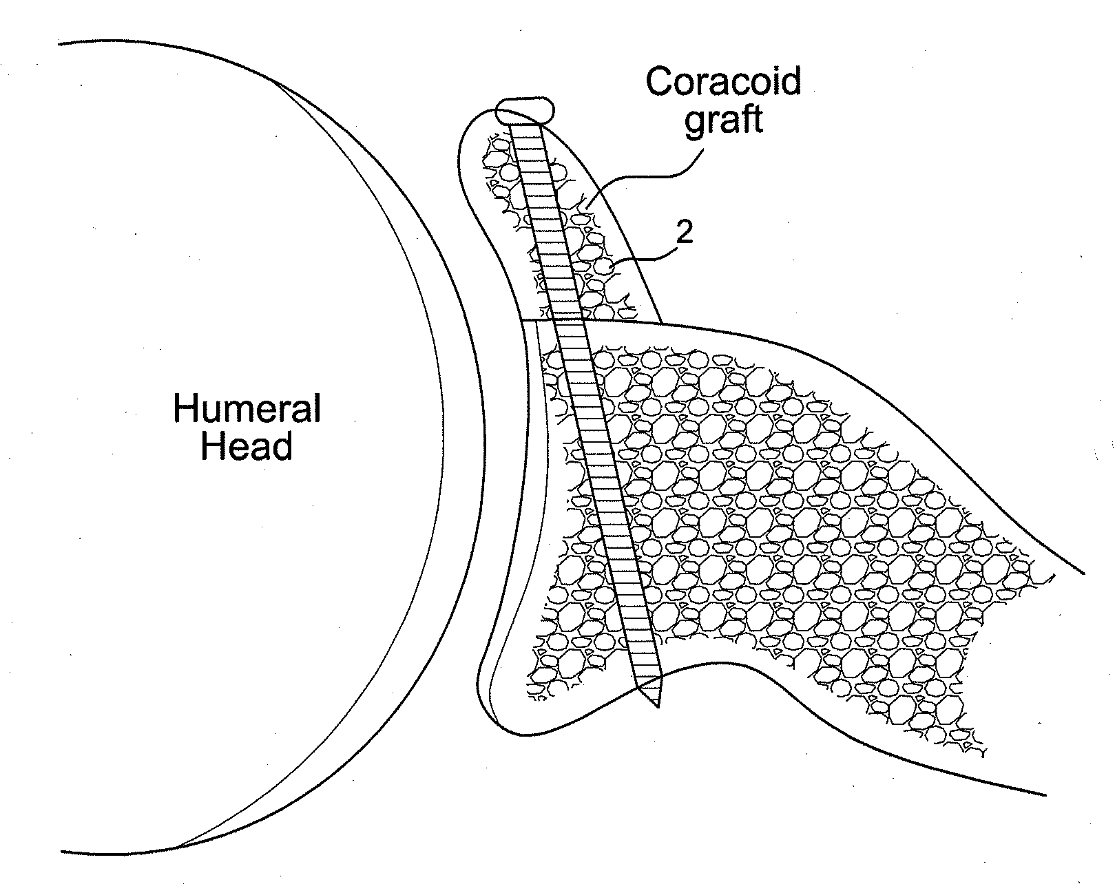 Latarjet instrumentation and method