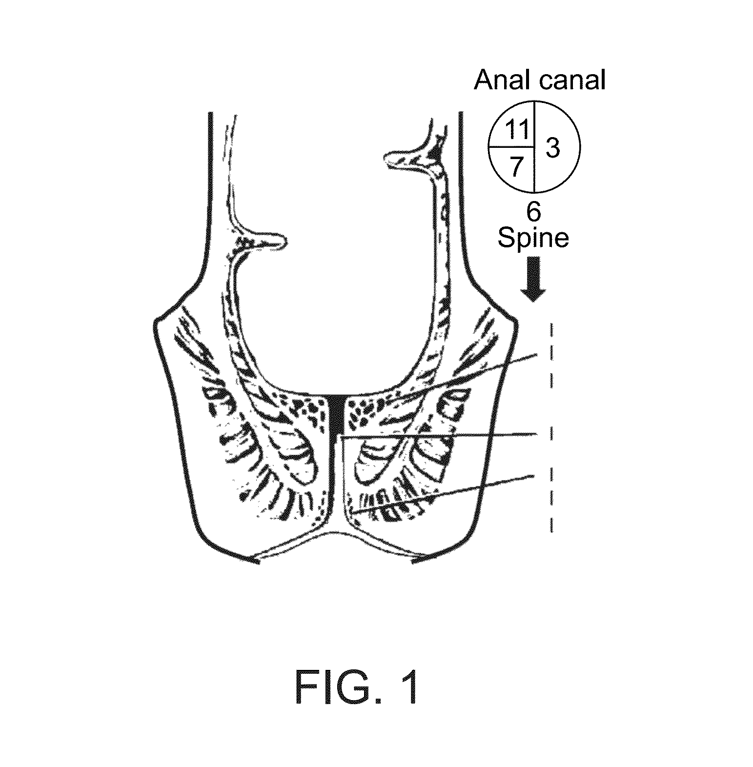 Device for protecting hemorrhoids