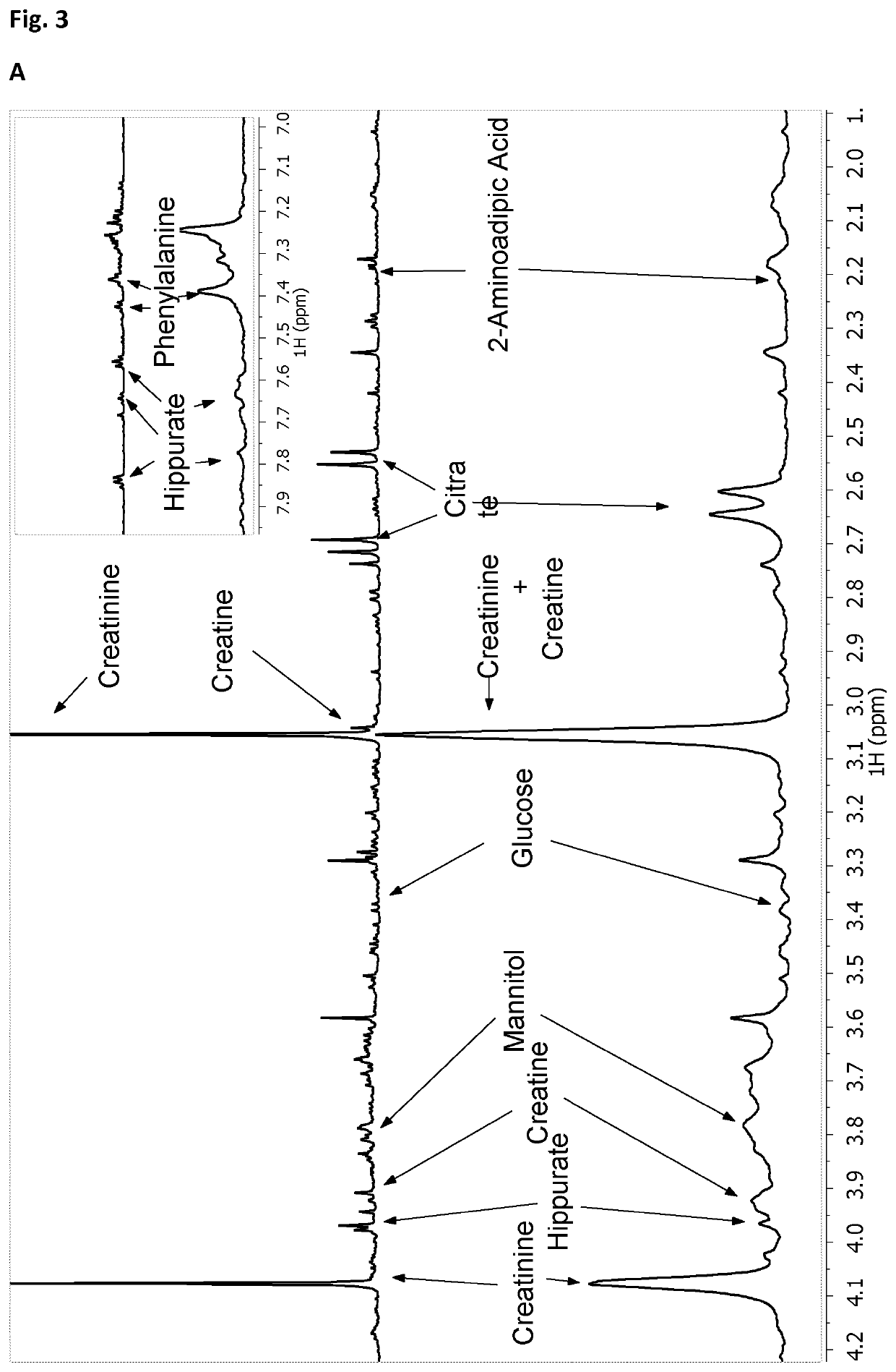 Identification of metabolomic signatures in urine samples for tuberculosis diagnosis