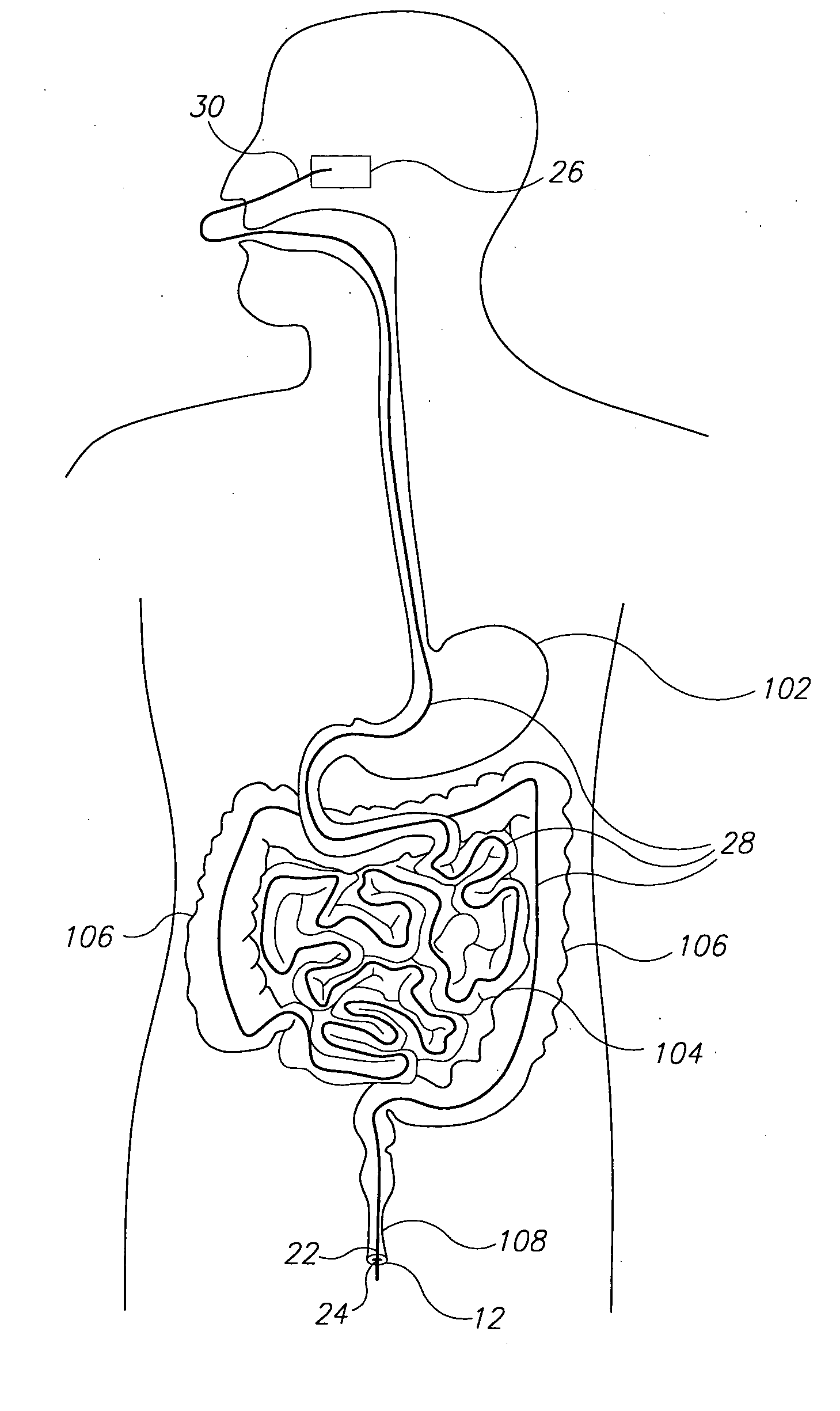 System and method for guiding of gastrointestinal device through the gastrointestinal tract