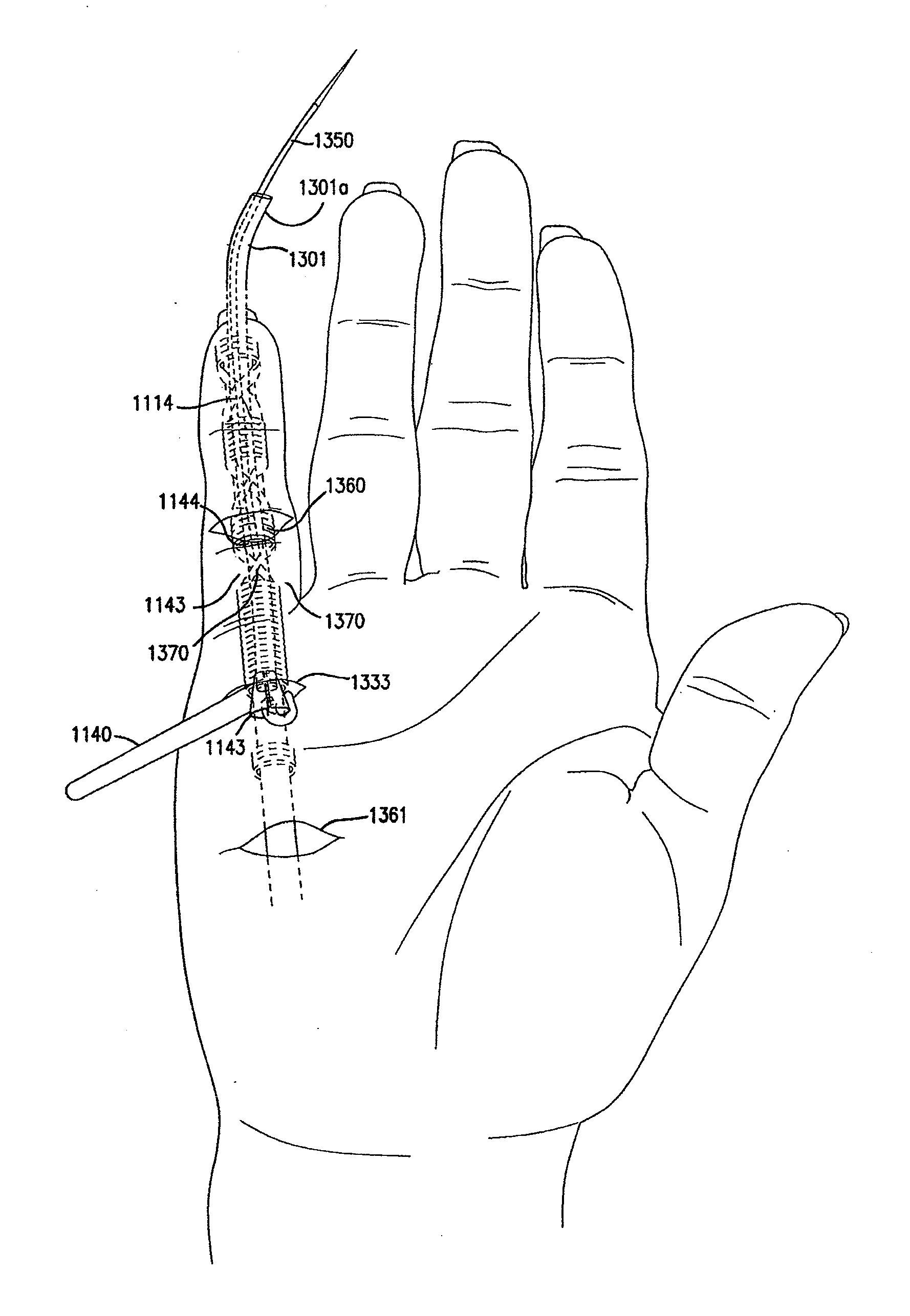 Method and apparatus for repairing a tendon or ligament