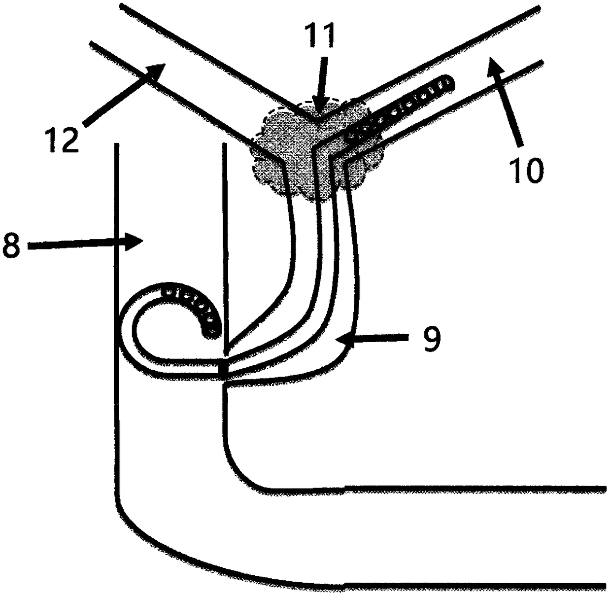 'J' type biliary stent for drainage of high biliary obstruction