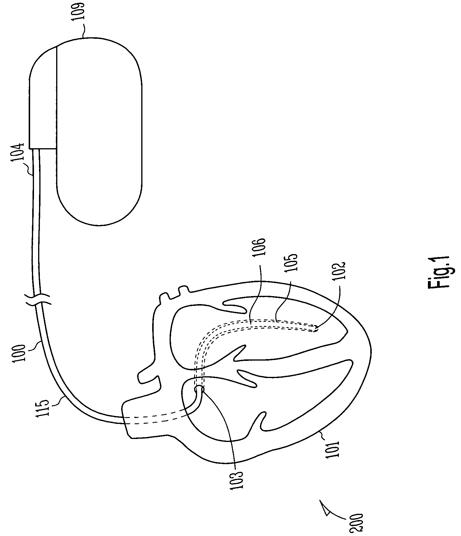 Lead having composite tubing