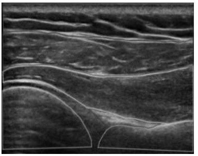 Shoulder muscle bone ultrasonic structure segmentation method based on semi-supervised semantic segmentation