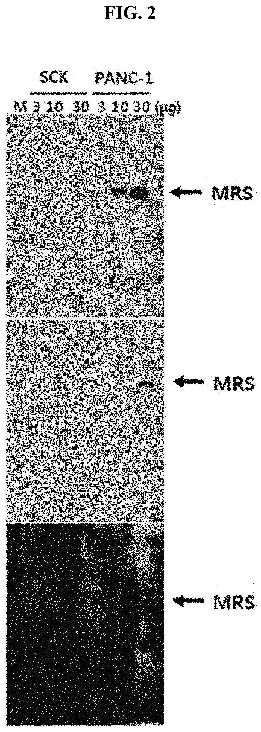 Method for diagnosing pancreatic cancer using methionyl-trna synthetase, and pancreatic cancer diagnostic kit using same